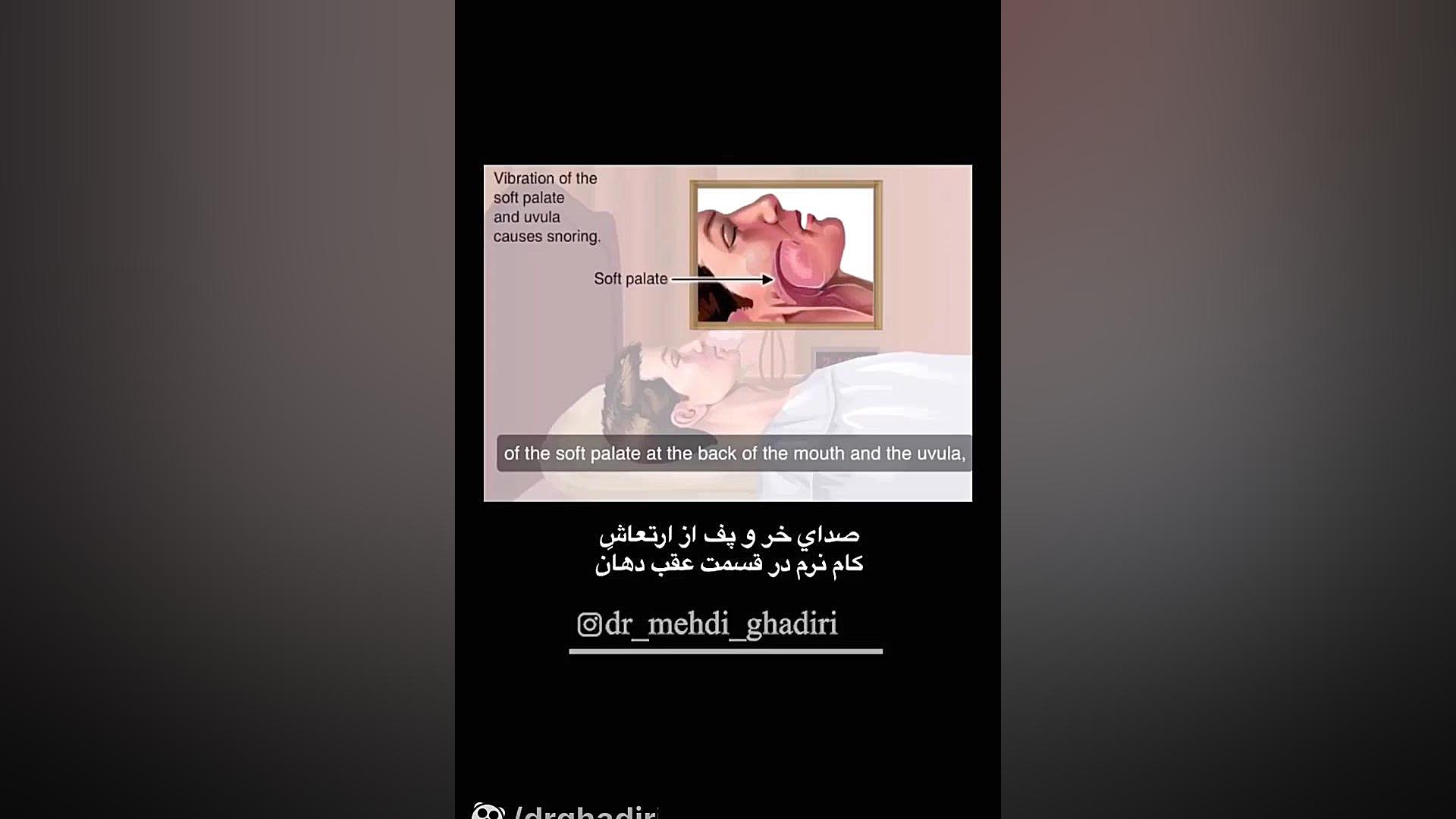 خروپف دکتر مهدی قدیری