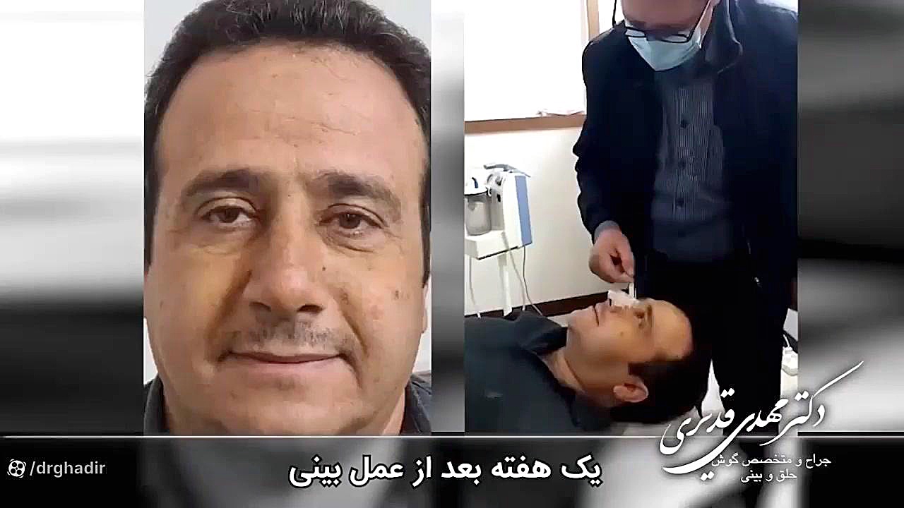 چسب زدن به بینی دکتر مهدی قدیری