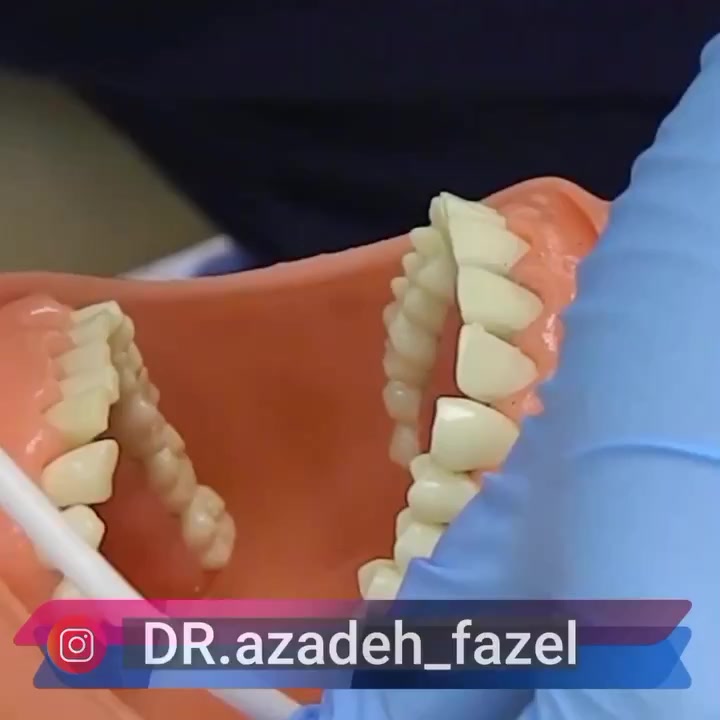 فلورایدتراپی کودکان چگونه انجام می شود؟ دکتر آزاده فاضل _ دندان پزشک کودکان