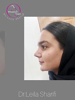 نمونه قبل و بعد عمل بینی - دکتر لیلا شریفی