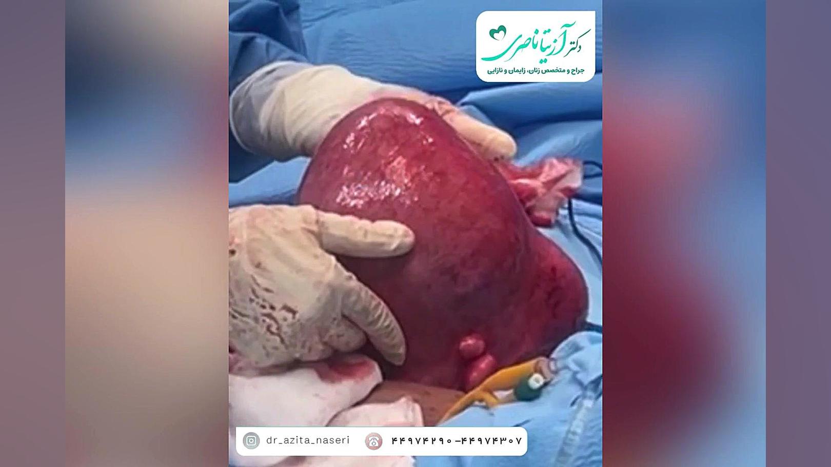 خارج کردن رحم با فیبروم های بسیار بزرگ دکتر آزیتا ناصری
