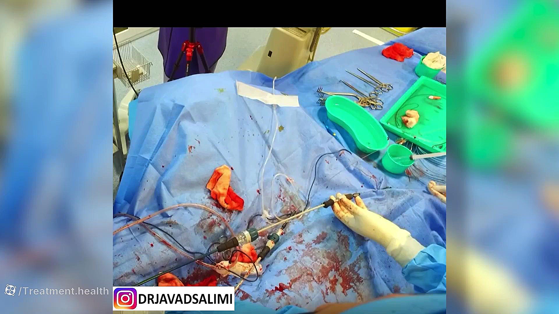 ترمیم آنوریسم آئورت شکمی به قطر دوازده سانتی متر به روش آندووسکولار کامپوزیت ونیر