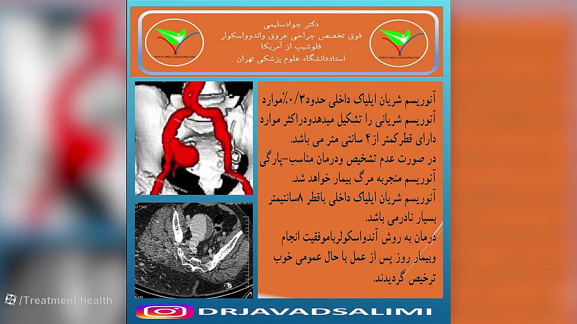 ترمیم آنوریسم شریان الیاک به قطر هشت سانتی متر به روش اندووسکولار پروتز سینه