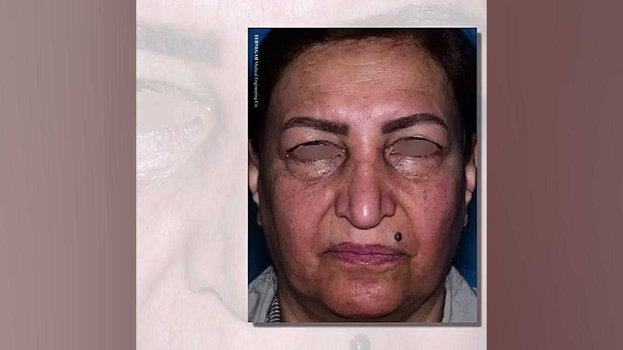 بلفاروپلاستی و لیفت اندوسکوپی ابرو دکتر حمید رضا فتحی فوق تخصص جراحی پلاستیک