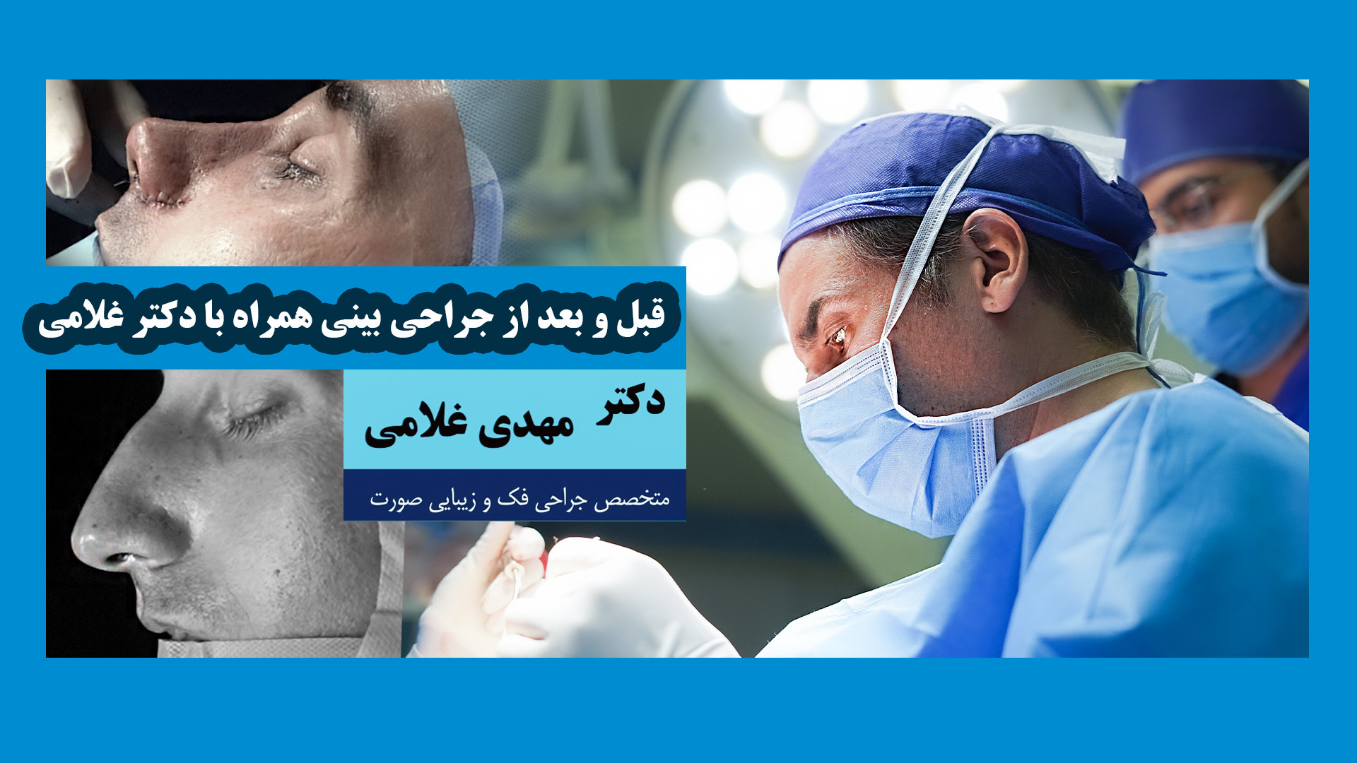قبل و بعد از جراحی بینی با دکتر مهدی غلامی در مشهد دکتر مهدی غلامی