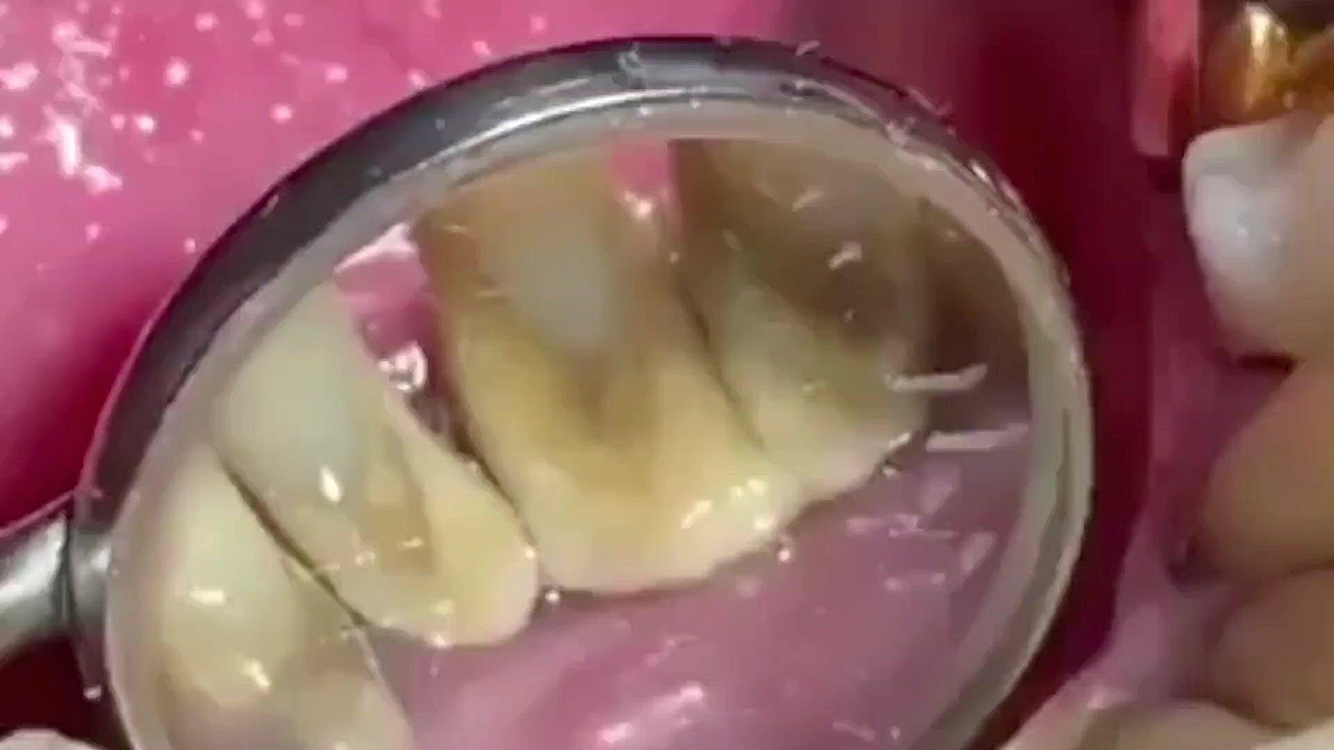 روش جرمگیری دندان دکتر مهسا حیدری