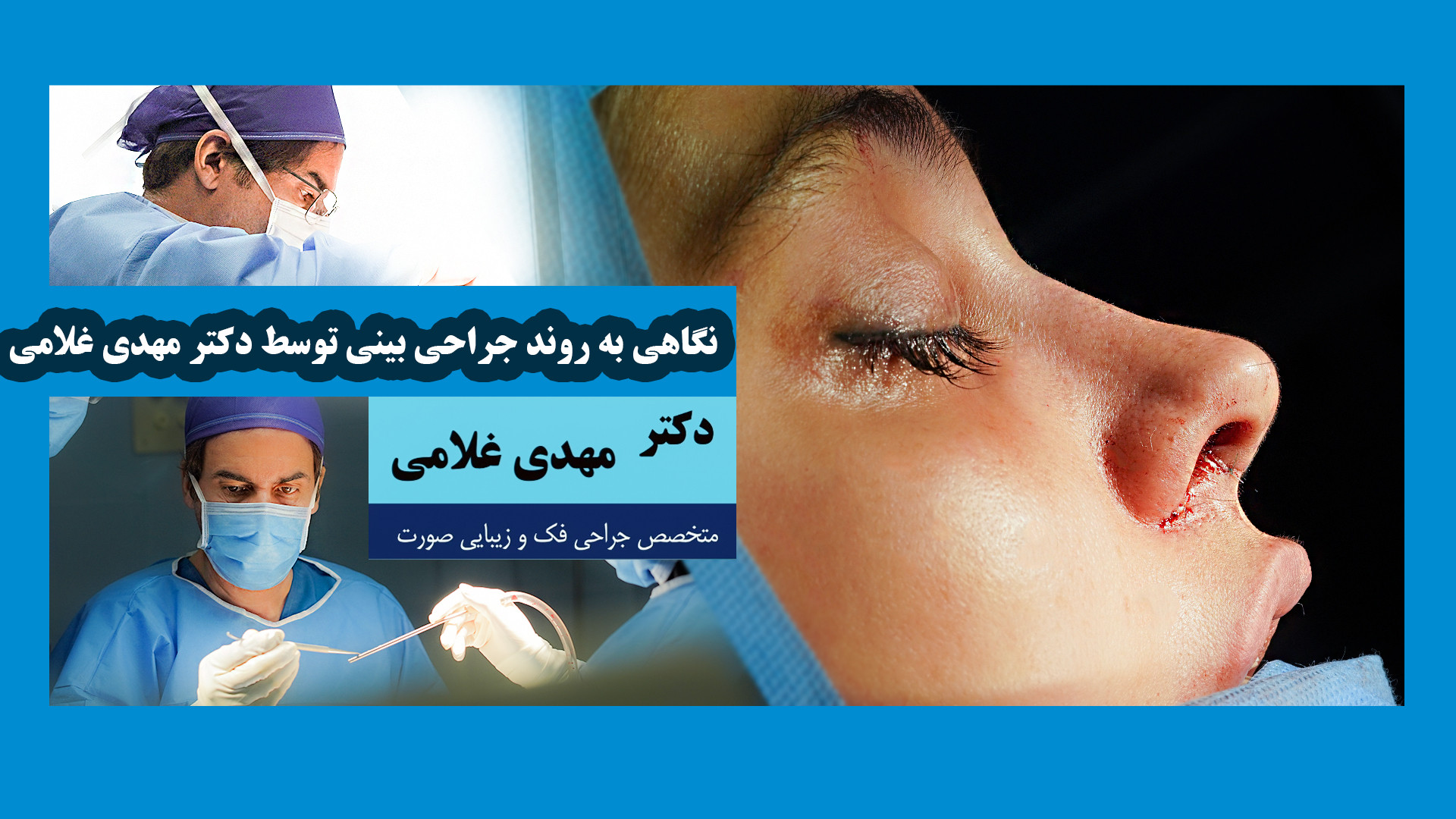 نگاهی به روند جراحی بینی توسط دکتر مهدی غلامی در مشهد دکتر مهدی غلامی