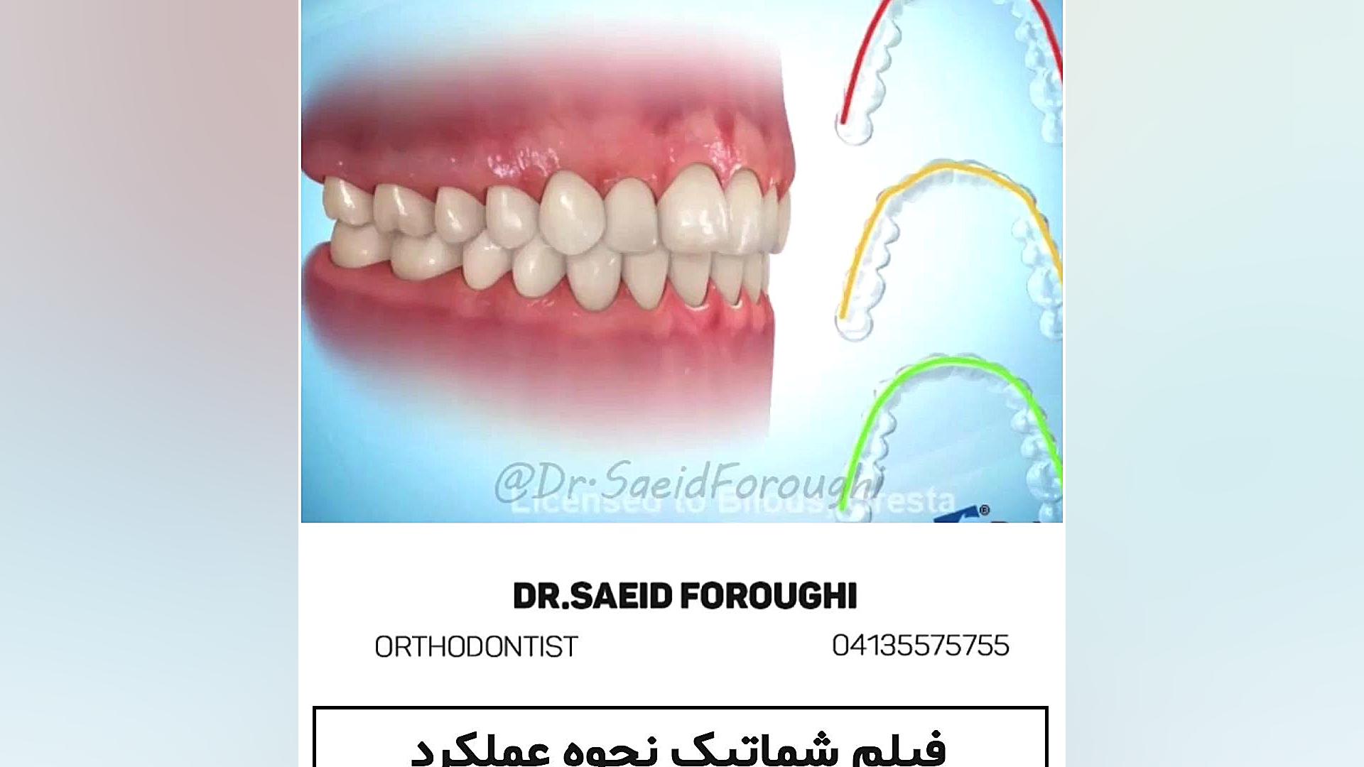 فیلم شماتیک در مورد نحوه عملکرد ارتودنسی با ردیف کننده های شفاف دکتر سعید فروغی متخصص ارتودنسی