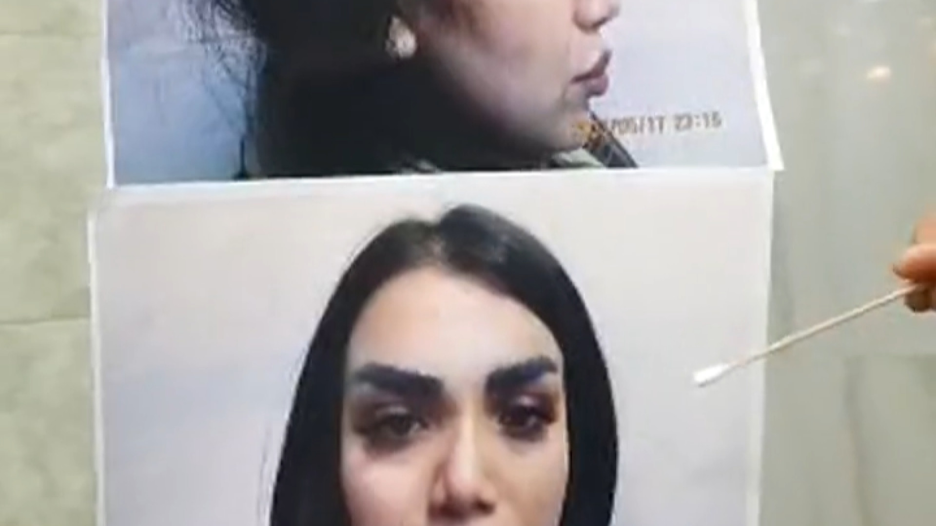 رینوپلاستی ثانویه با کمک غضروف و دنده دکتر محمودرضا اصحاب یمین - فوق تخصص پلاستیک