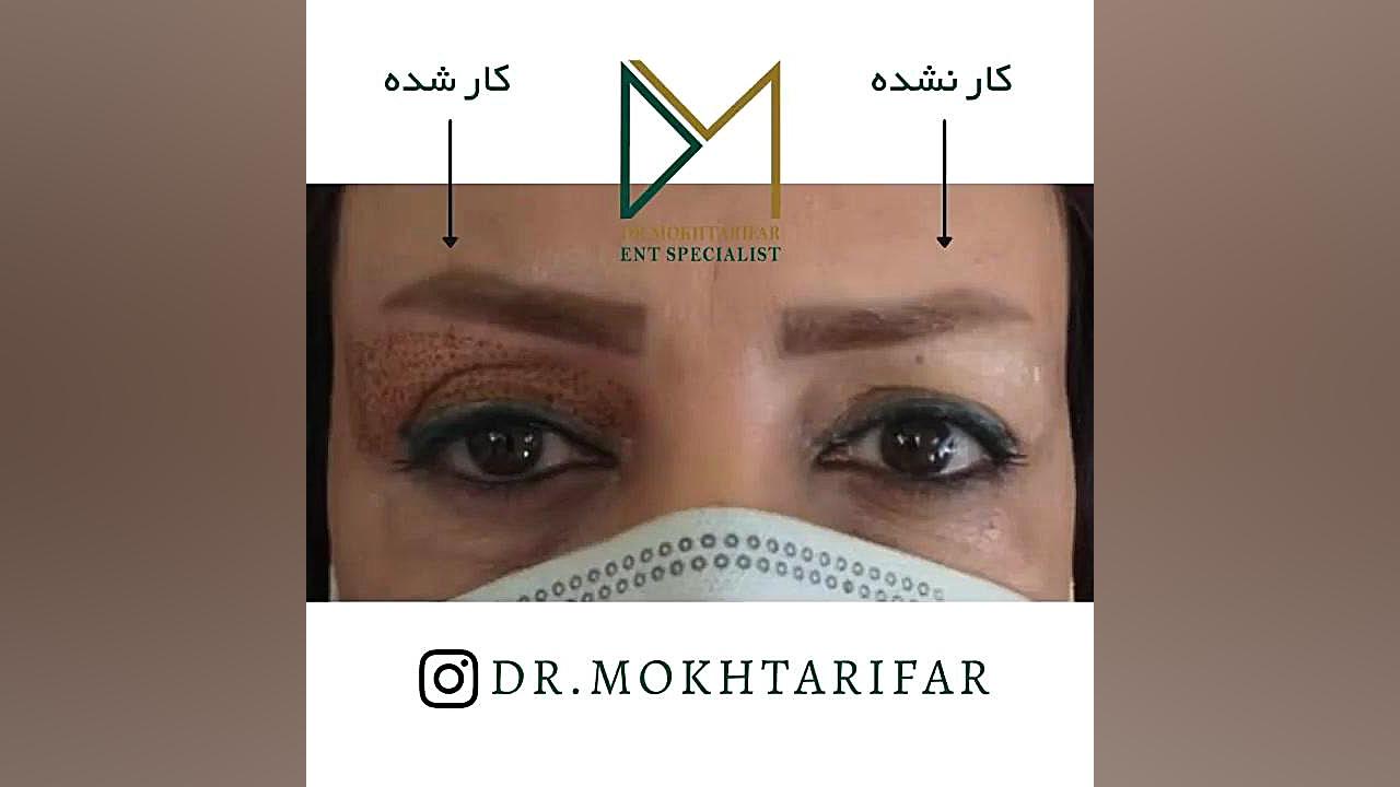 نتیجه پلکسر پلاس فرکشنال دکتر فاطمه مختاری فر جراح بینی در لرستان