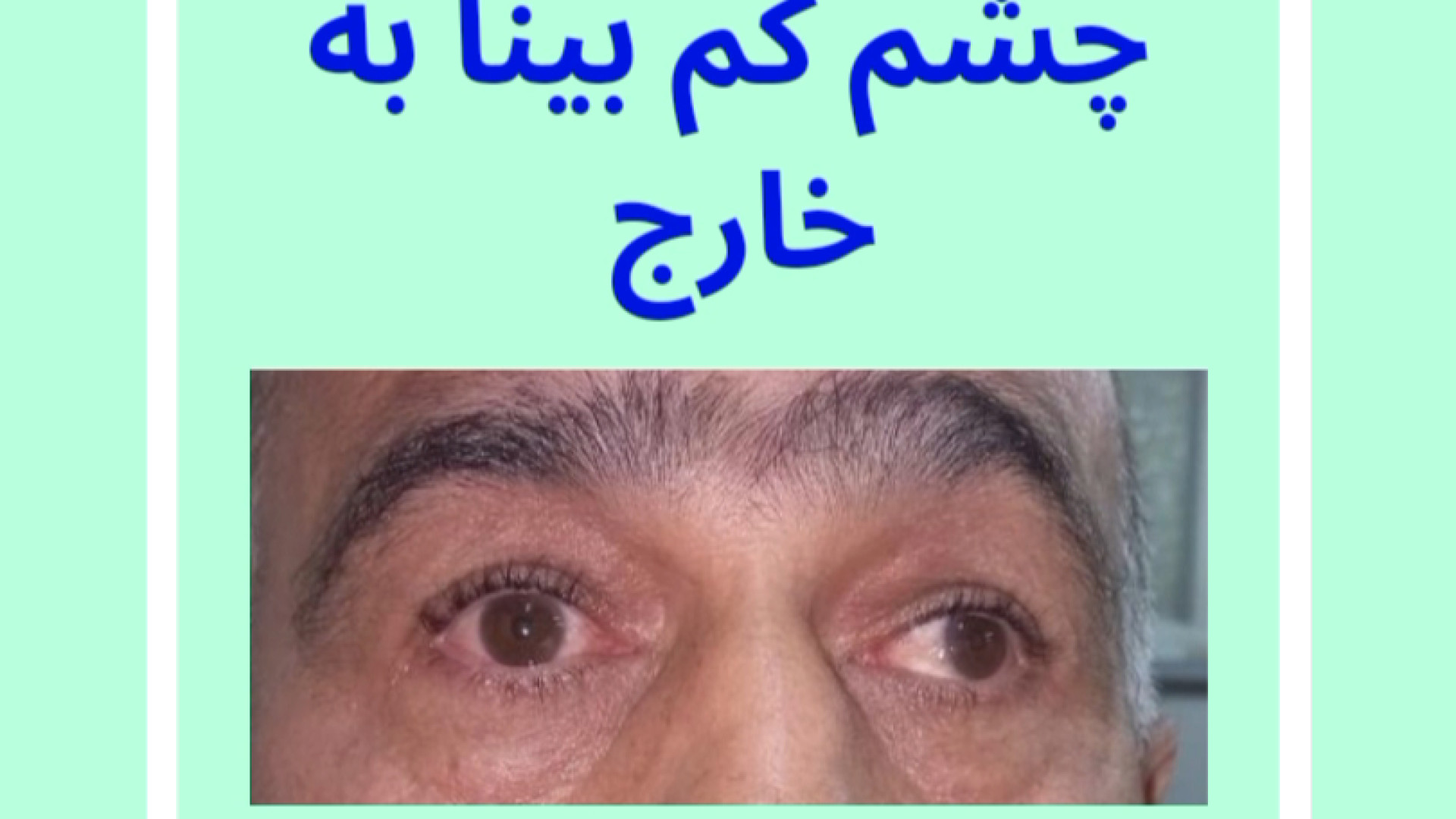 جراحی انحراف چشم بدون بیهوشی عمومی در پانزده دقیقه، دکتر گزین فوق تخصص استرابیسم کاشت ریش