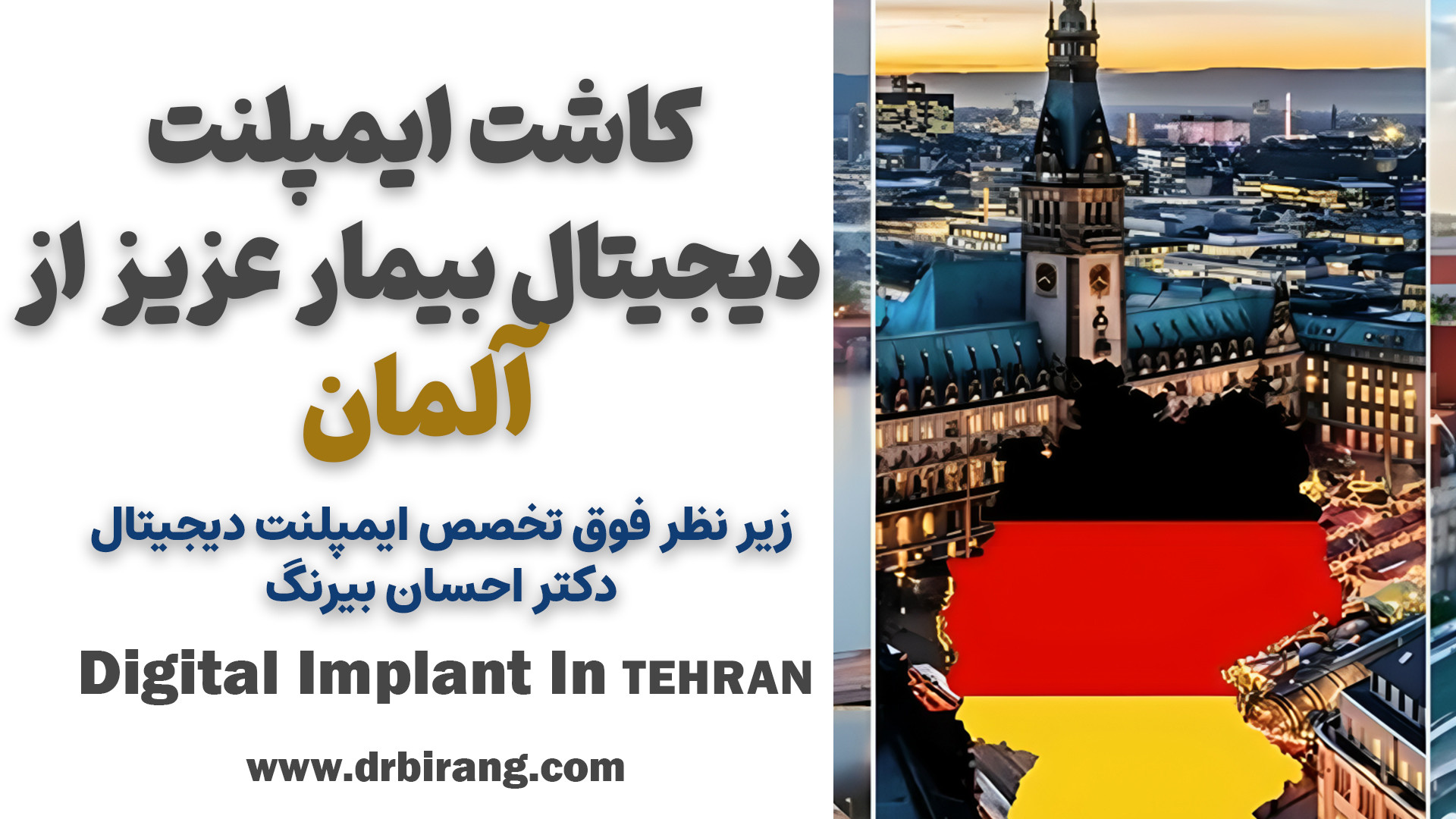 کاشت ایمپلنت دیجیتال مراجعه کننده عزیز از آلمان دکتر احسان بیرنگ
