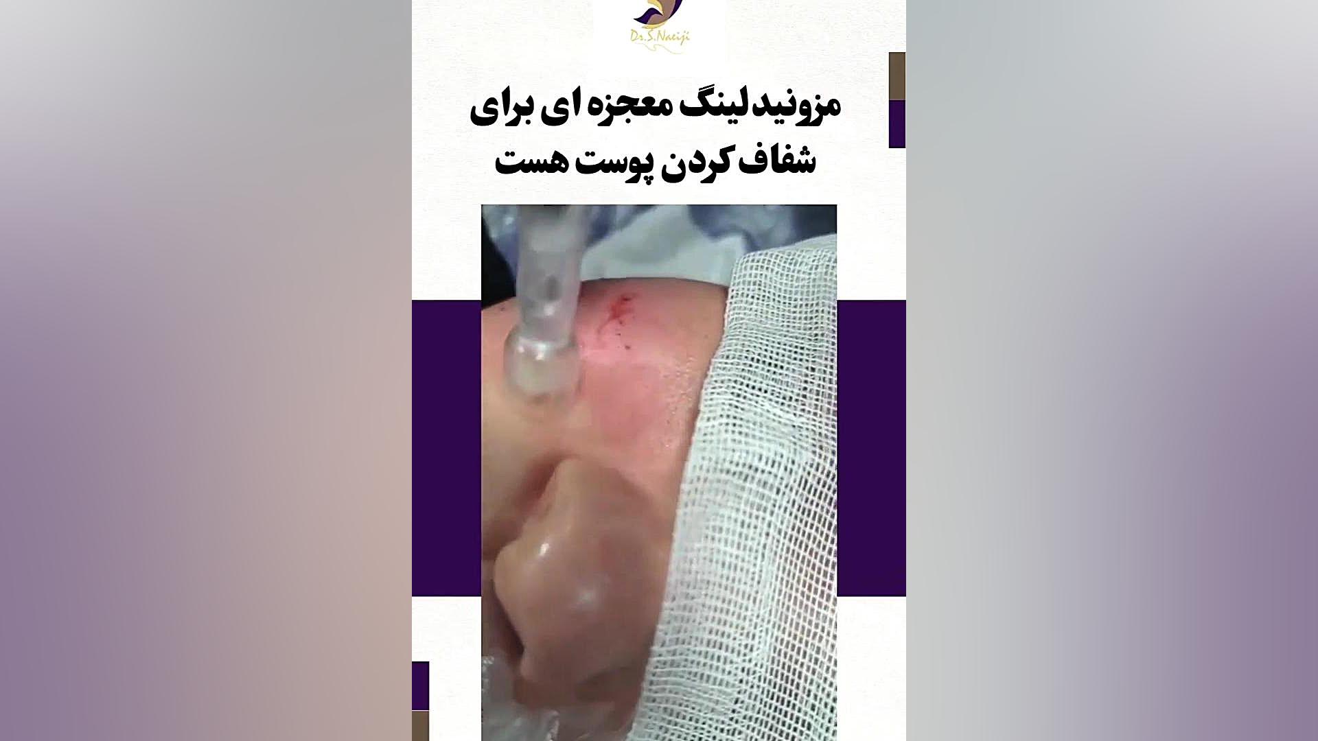مزونیدلینگ برای شفاف کردن پوست دکتر صدیقه نائیجی | متخصص پوست و مو در قم
