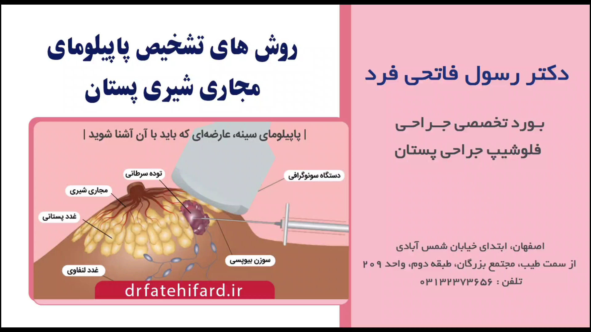 روش های تشخیص پاپیلوما در مجاری شیری پستان | بهترین جراح پستان اصفهان پالپوتومی