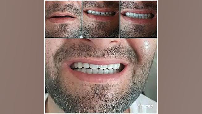 دندان مصنوعی و لابراتوار دندانسازی آرش منبری در سنندج 09188719088 لیزر کوانتومی جراحی چشم