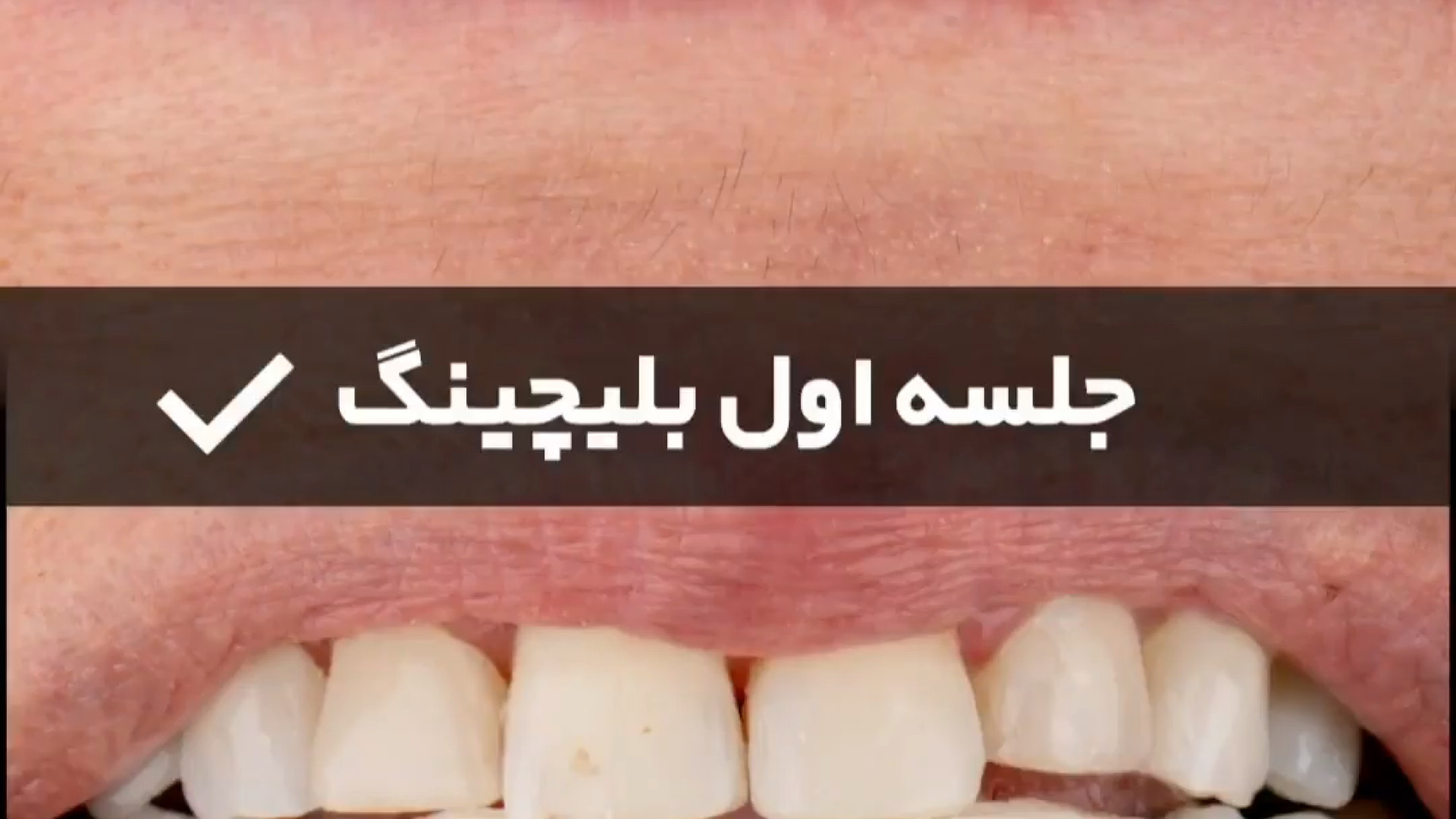 بلیچینگ دندان در کلینیک دندان پزشکی دریای نور دستکش جراحی حساسیت بالا