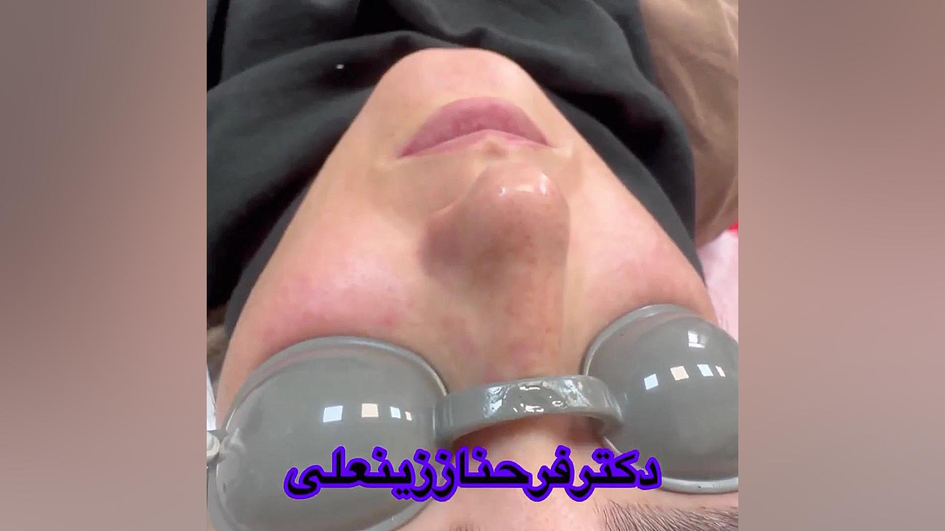 تزریق فیلر برای رفع انحراف بینی توسط دکتر فرحناز زینعلی دکتر فرحناز زینعلی - متخصص پوست، مو، زیبایی زنجان