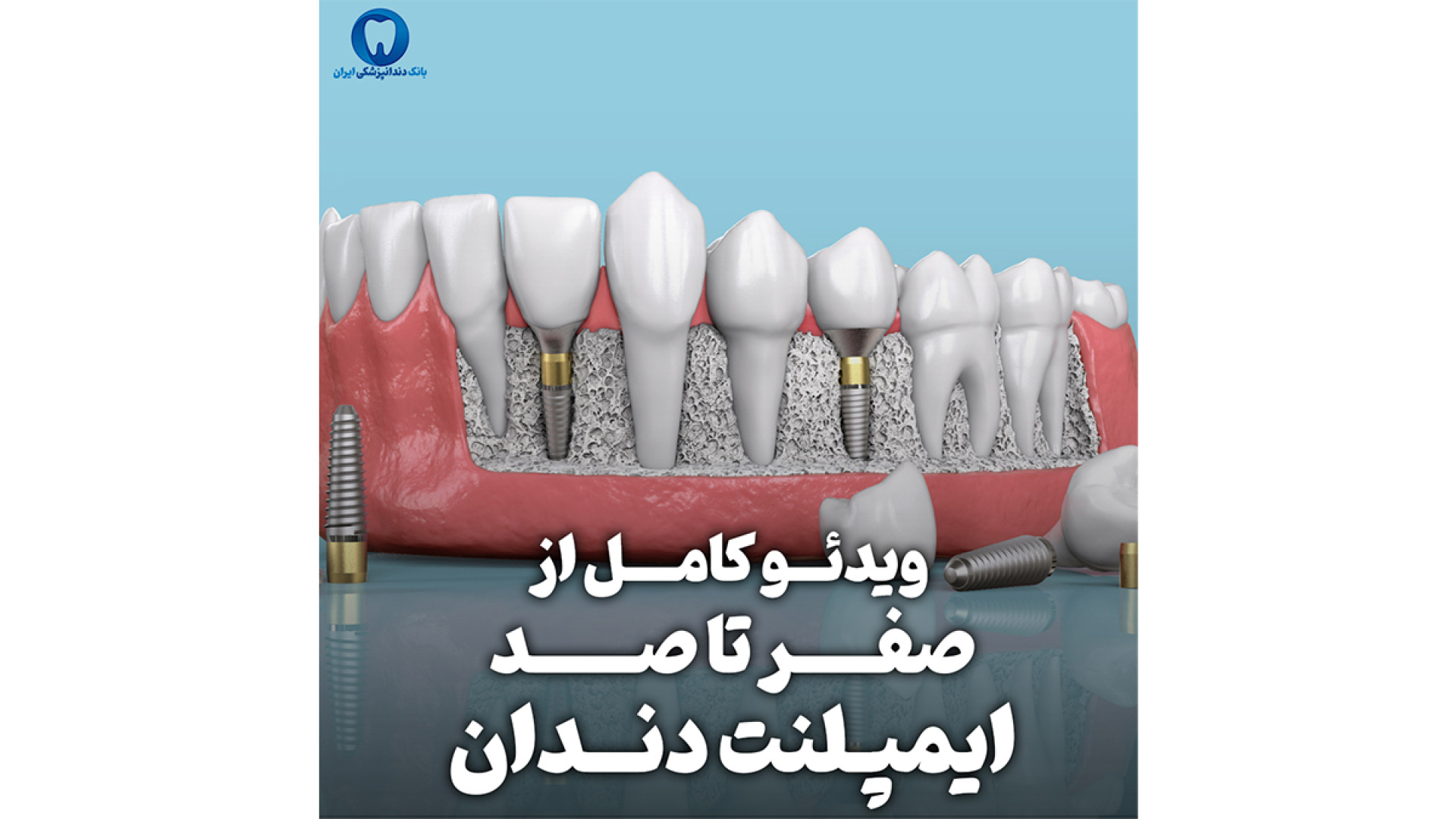 فیلم انجام عمل ایمپلنت دندان FVC