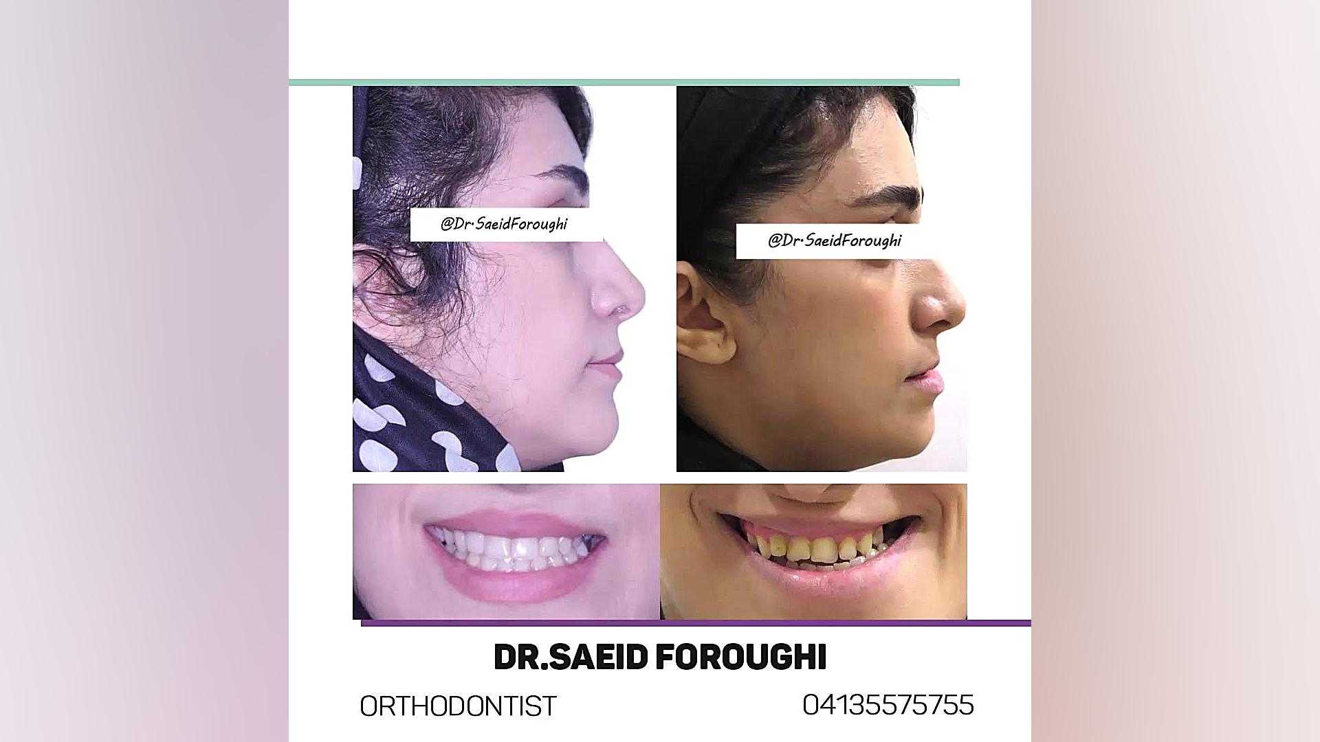 درمان ترکیبی ارتودنسی و جراحی فک جهت اصلاح ناقرینگی و جلوزدگی فک پایین دکتر سعید فروغی متخصص ارتودنسی