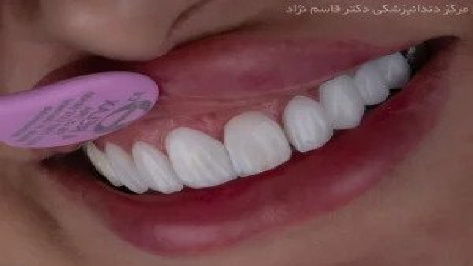 فیلم لمینت دندان ایمکس دندانپزشکی زیبایی دکتر قاسم نژاد