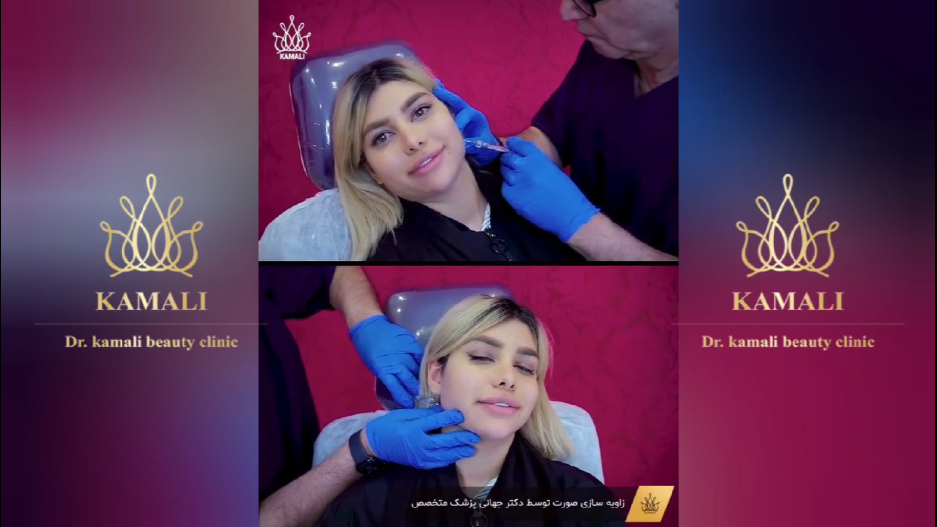 زاویه سازی صورت کربتوزوماب