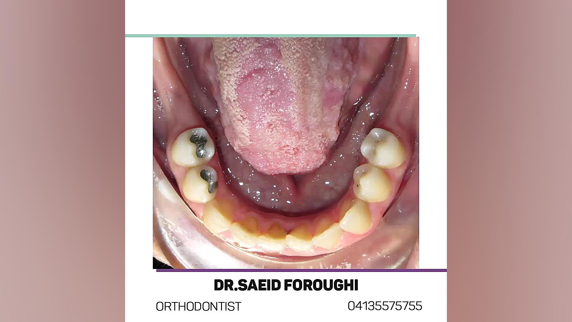 درمان ترکیبی ارتودنسی و جراحی فک جهت اصلاح ناقرینگی و جلوزدگی فک پایین دکتر سعید فروغی متخصص ارتودنسی