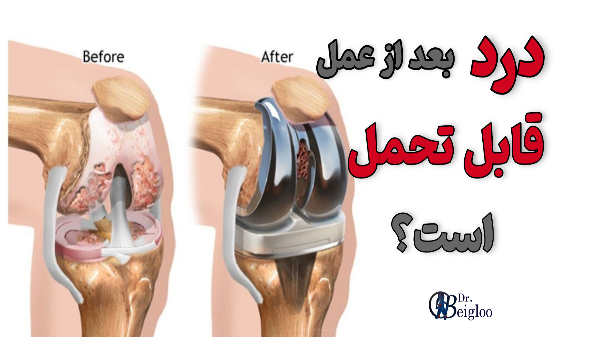 آیا درد پس از تعویض مفصل قابل تحمل است ؟ دکتر محمود جعفر بیگلو