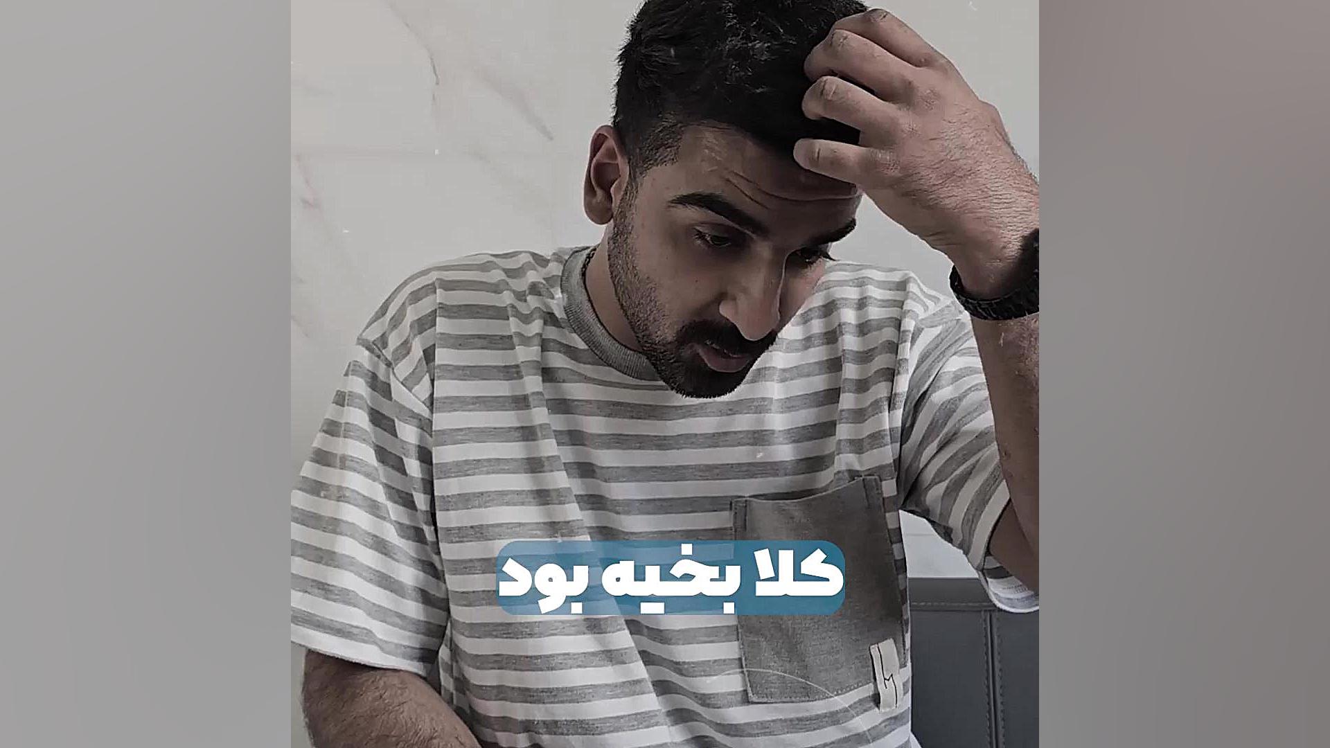 کاشت مو در جای زخم - دکتر سارا سلطانی لیپوماتیک