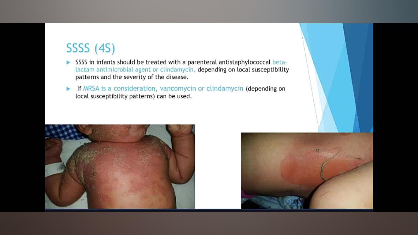 آقای دکتر محمدرحیم کدیور(آنتی بیوتیک ها با پوشش گرم مثبت) بلیچینگ