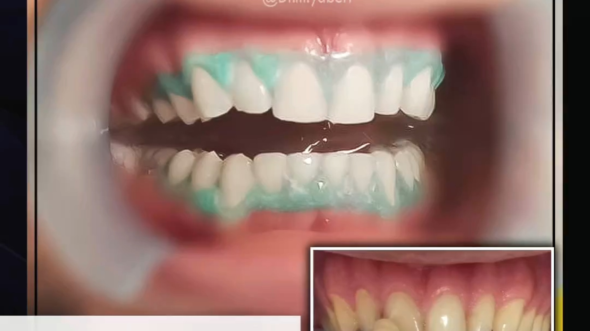آفیس بلیچینگ دندان MRCP