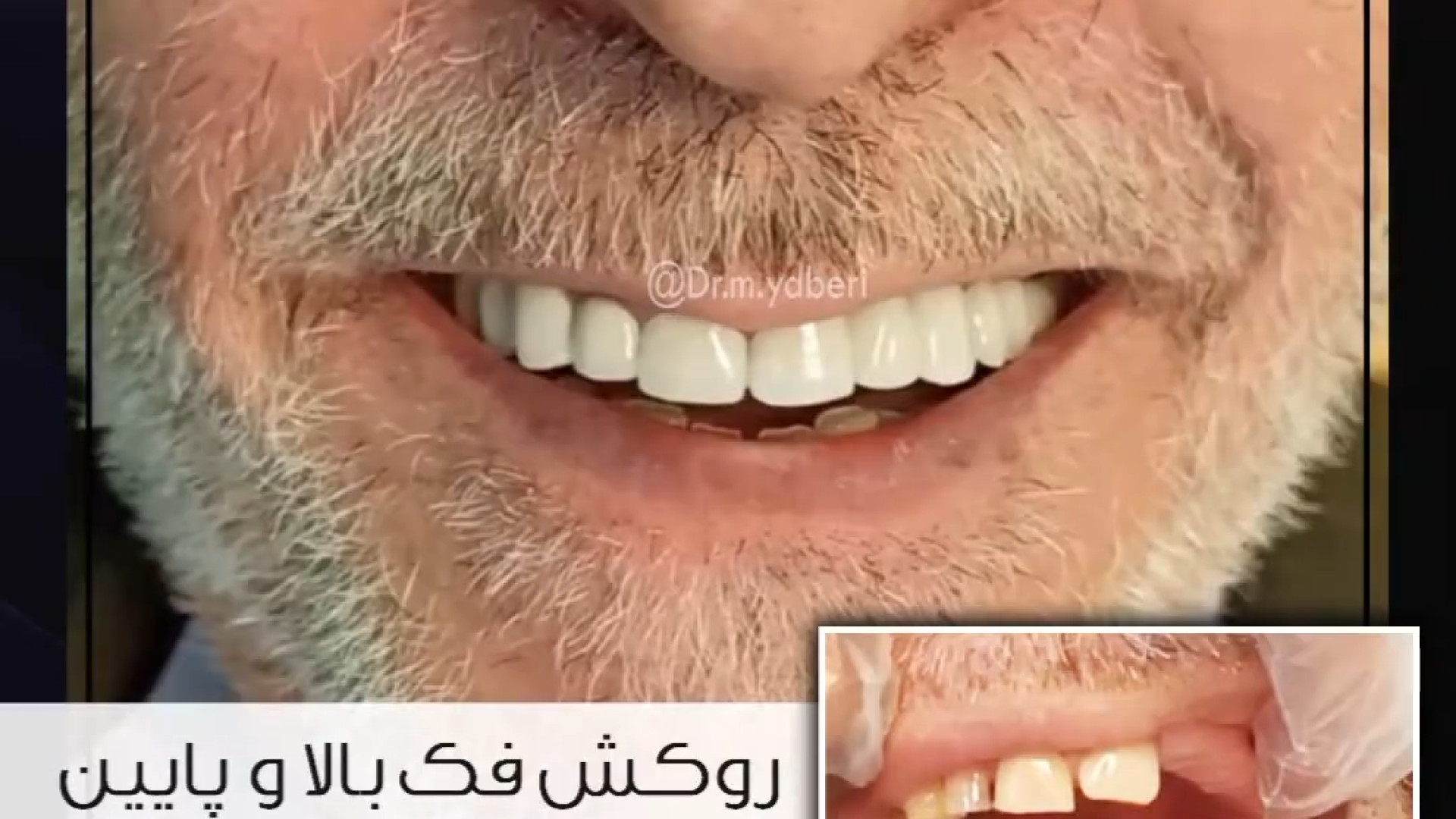 روکش دندان ها در فک بالا و پایین اصلاح طرح لبخند