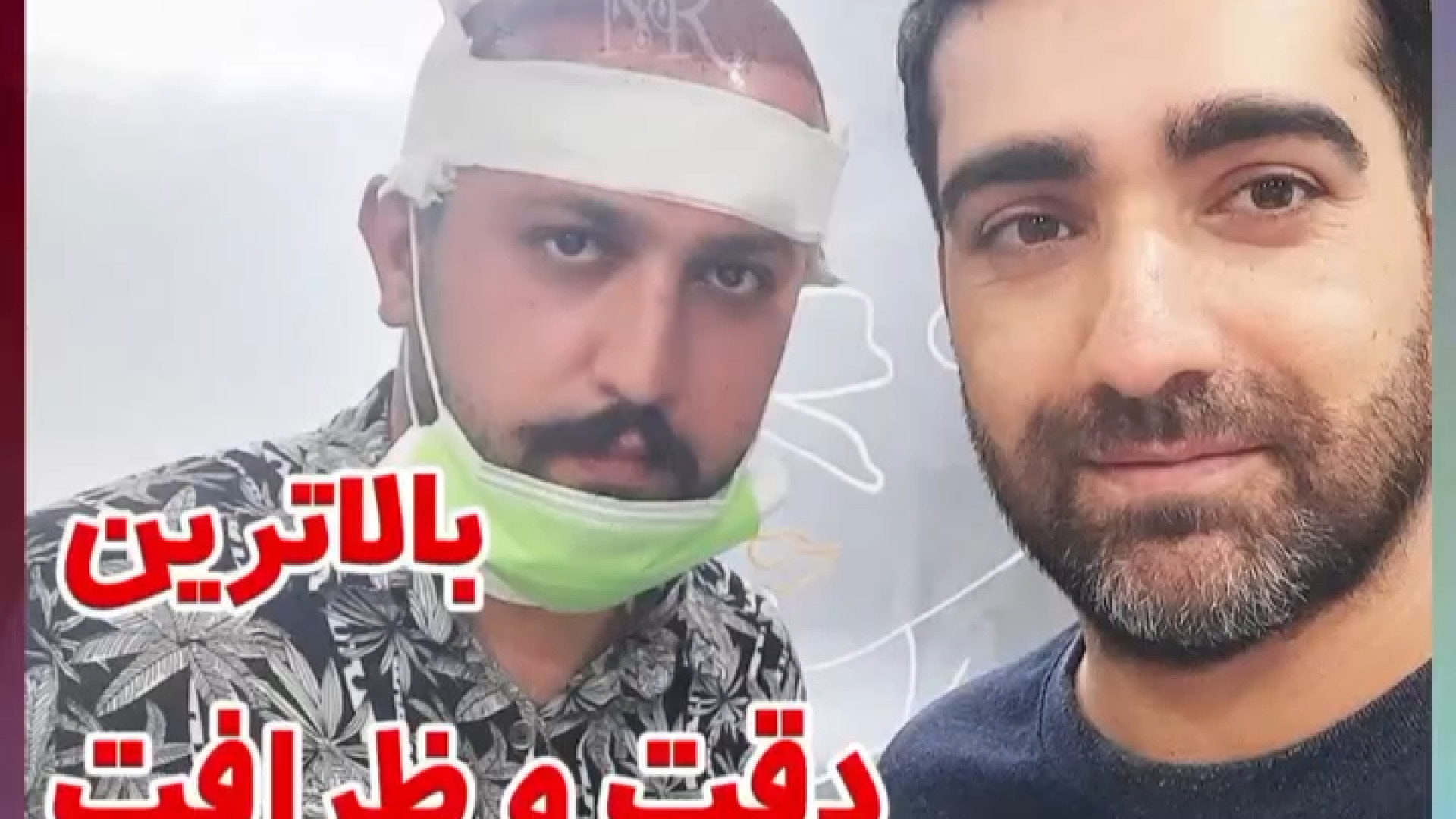 کاشت مو با بانک مو ضعیف طب پرواز