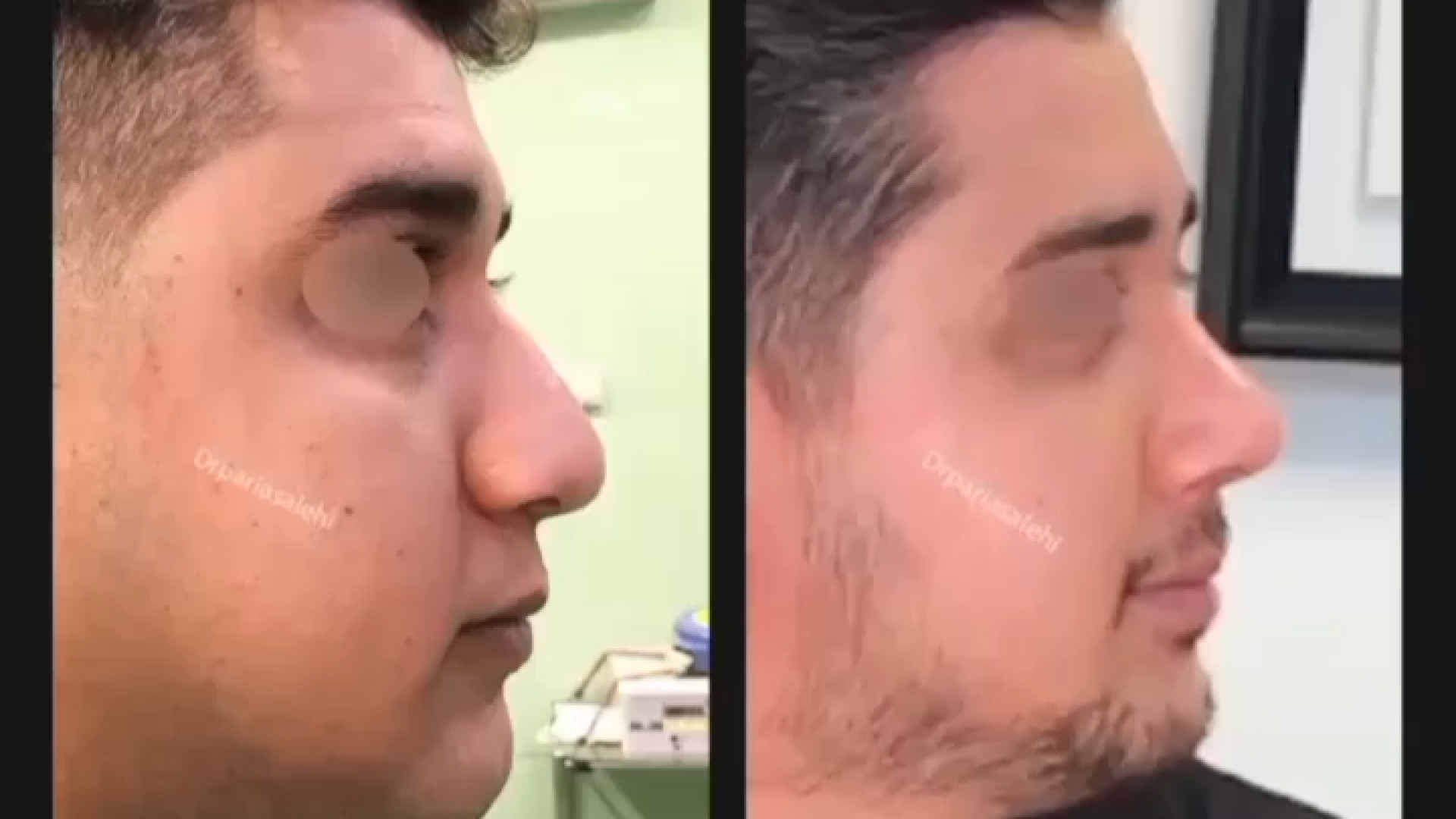 جراحی پولیپوز بینی دکتر پریا صالحی ✔ بهترین جراح بینی تهران