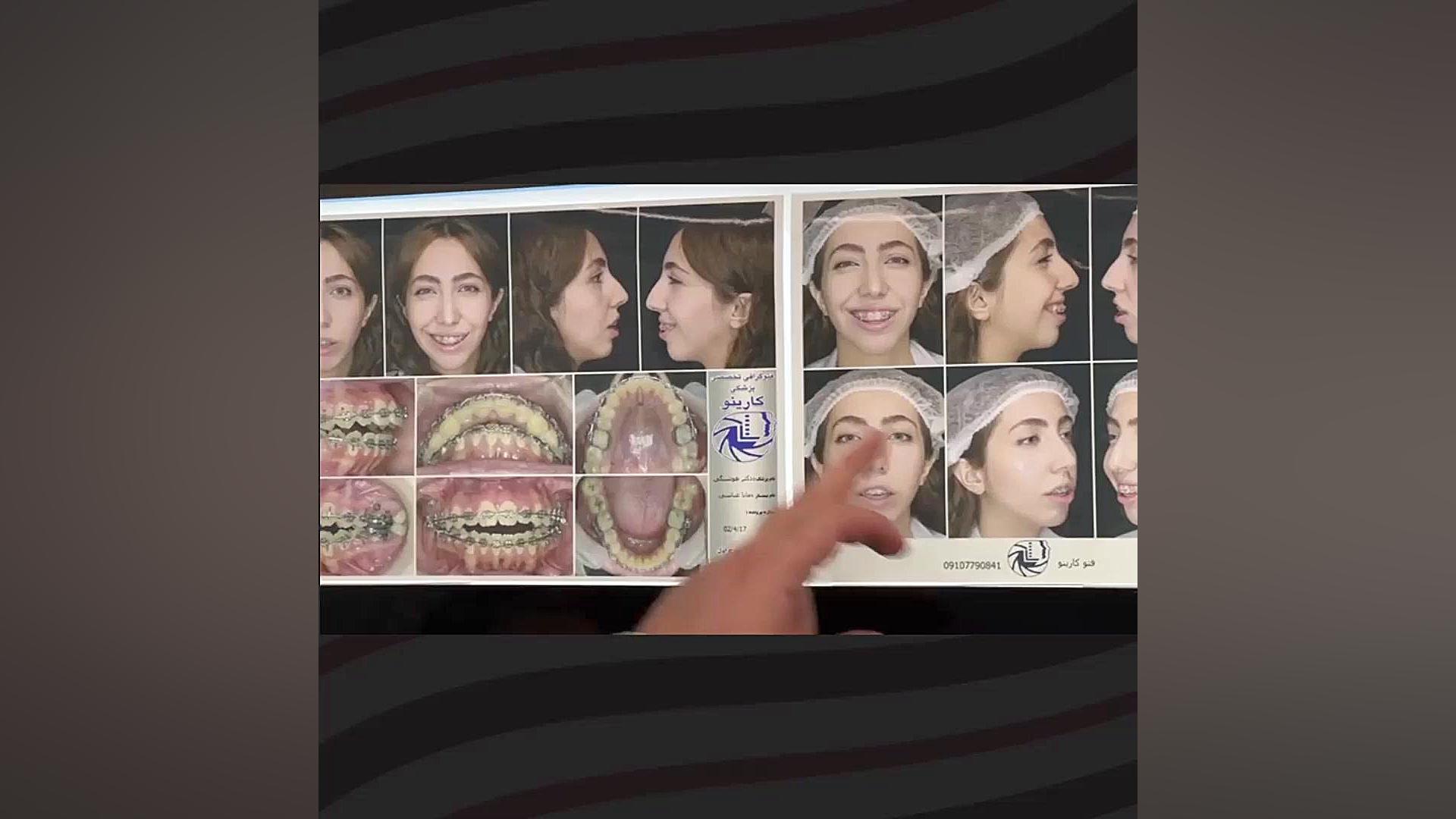 اصلاح لبخند لثه ای پروتز دندان