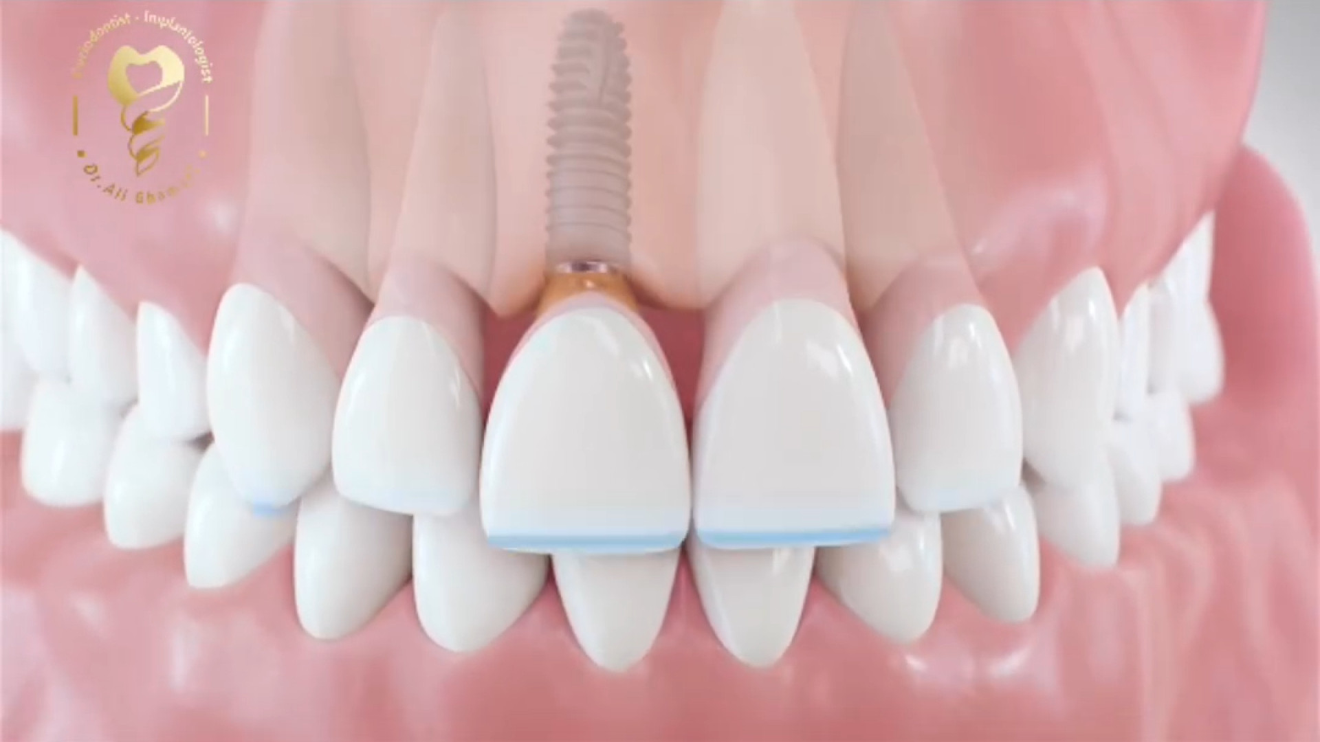 ماندگاری ایمپلنت دکتر علی قمری - متخصص جراحی لثه و ایمپلنت