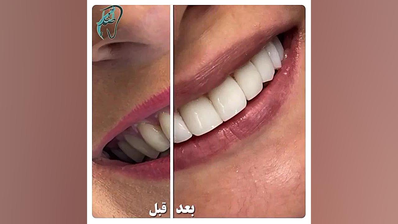 کامپوزیت ونیر ده دندان فک بالا درمان جای جوش