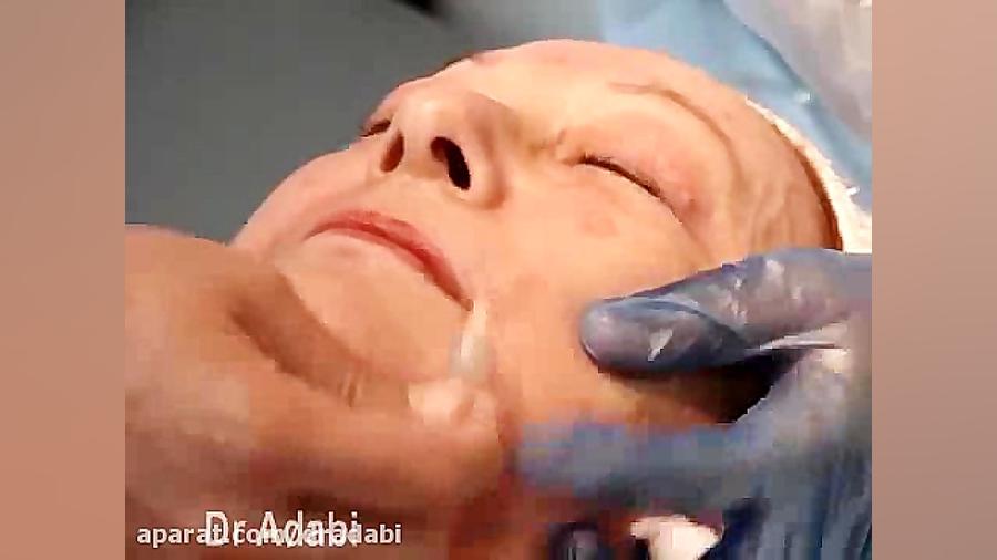 کربوکسی تراپی دکتر مرتضی ادبی (متخصص پوست،مو و زیبایی)