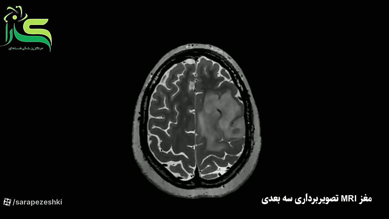 تصویربرداری سه بعدی MRI مغز لیفت پیشانی