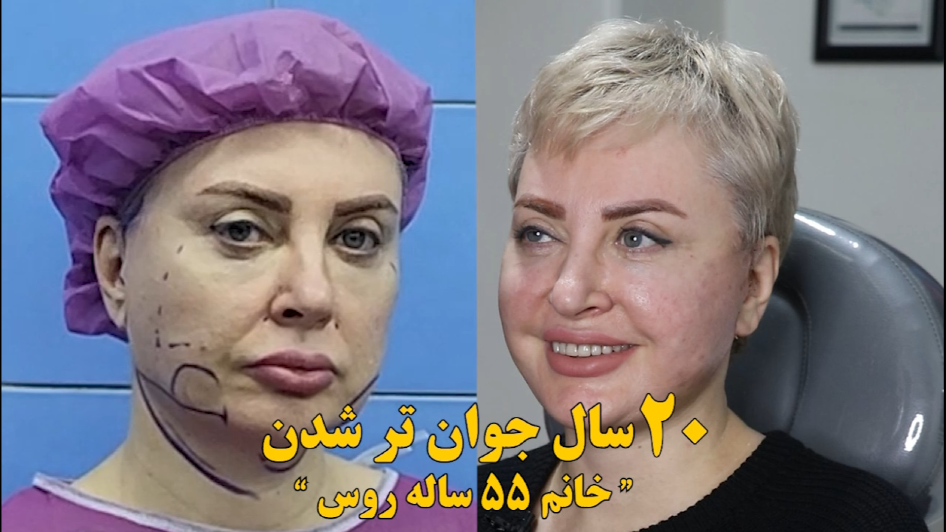مینی لیفت صورت و گردن، مجموعه زیبایی دنیز میکرونیدلینگ