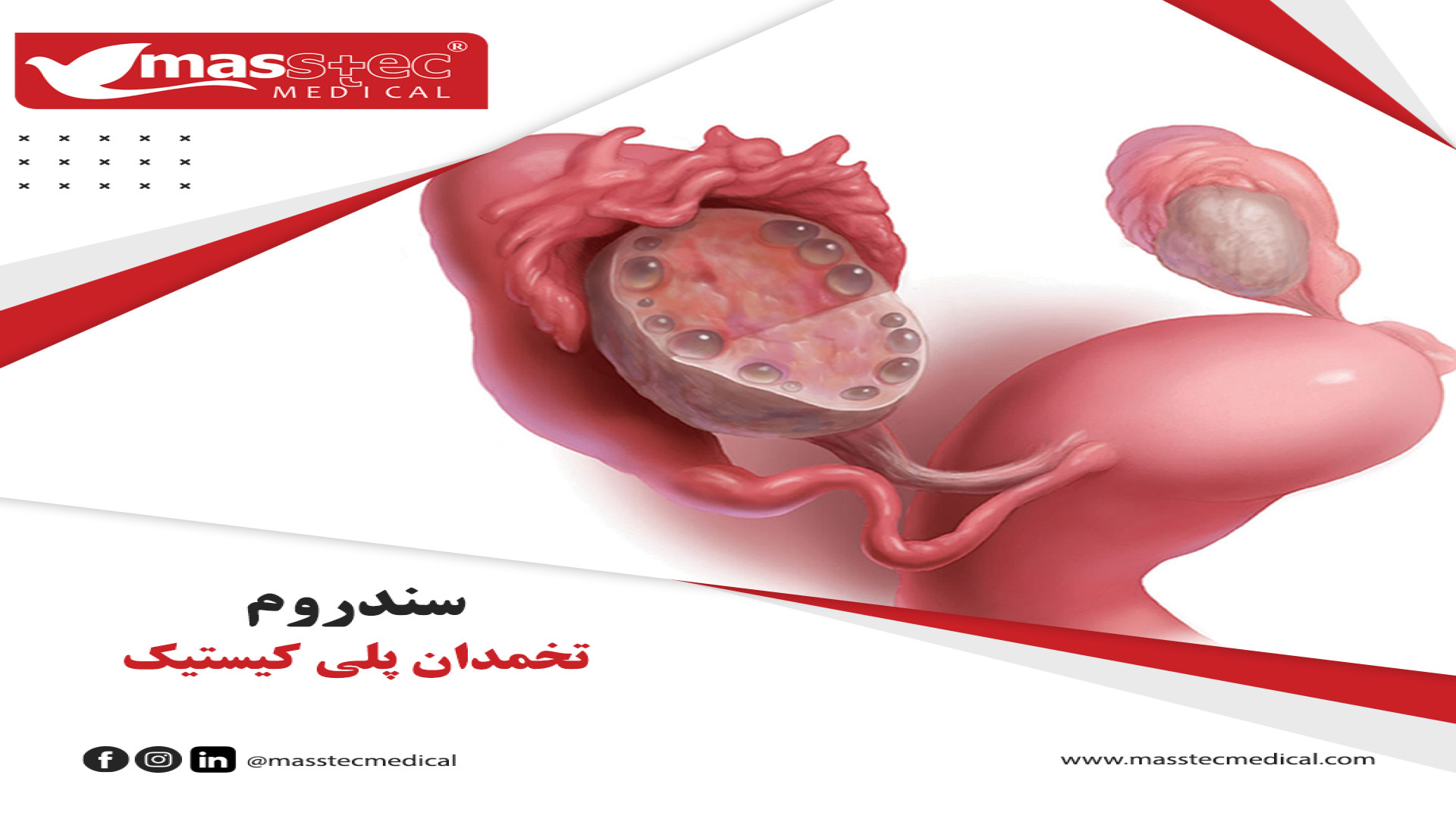 تخمدان پلی کیستیک و ناباروری پر کردن دندان