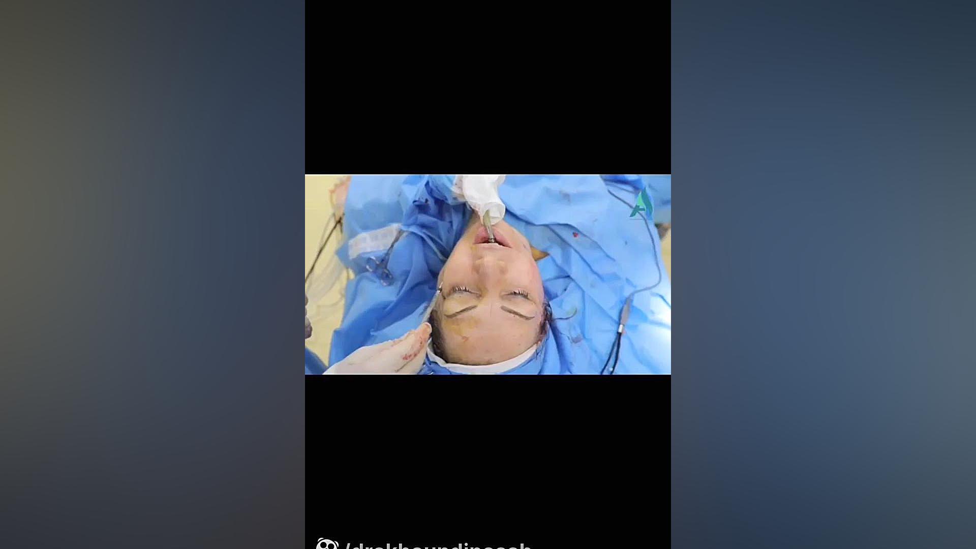 جراحی لیفت عمقی صورت | قسمت آخر دکتر محمدرضا آخوندی نسب-فوق تخصص جراحی پلاستیک