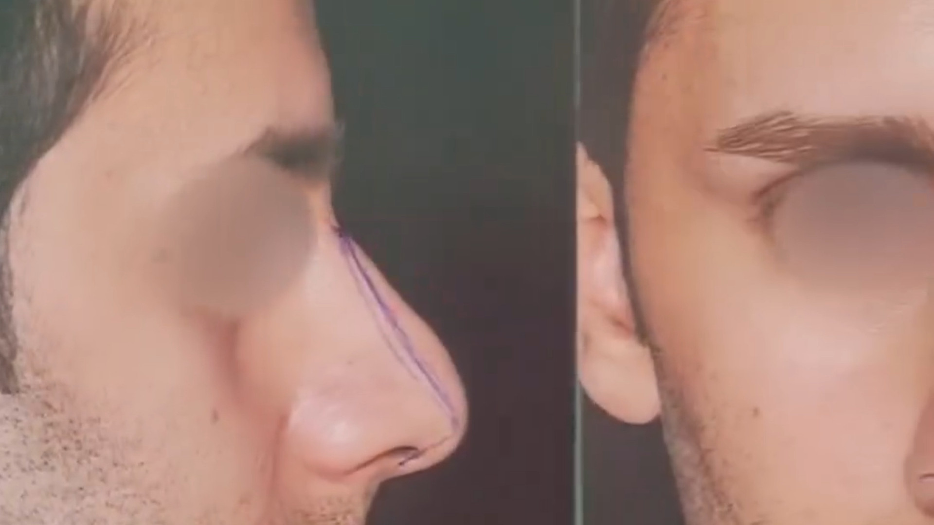 جراحی بینی گوشتی بزرگ با سابقه ی سه بار شکستــــگی دکتر کامران بابایی