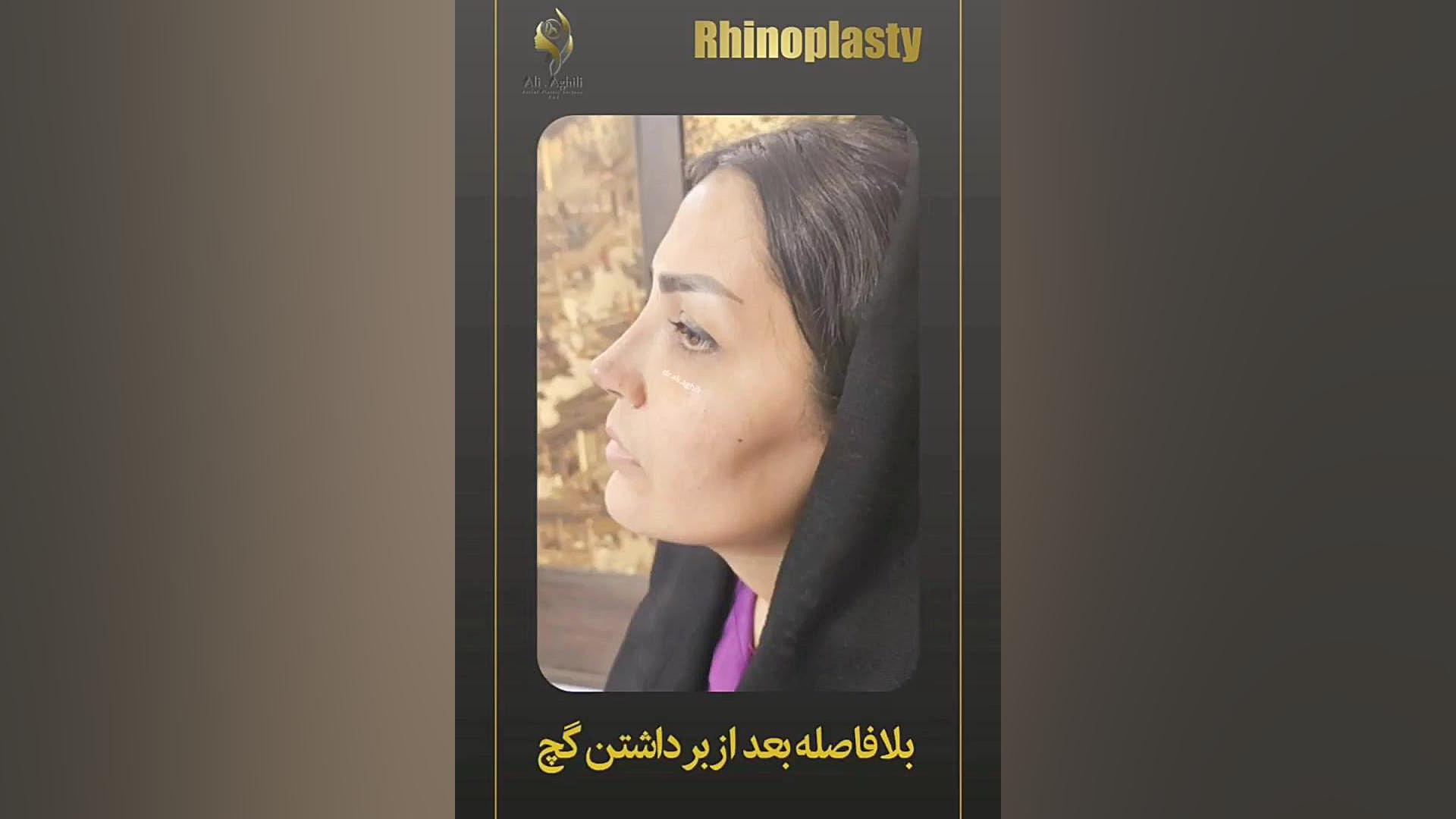 جراحی بینی استخوانی زنانه با پوست نازک دکتر علی عقیلی - جراح بینی در تهران