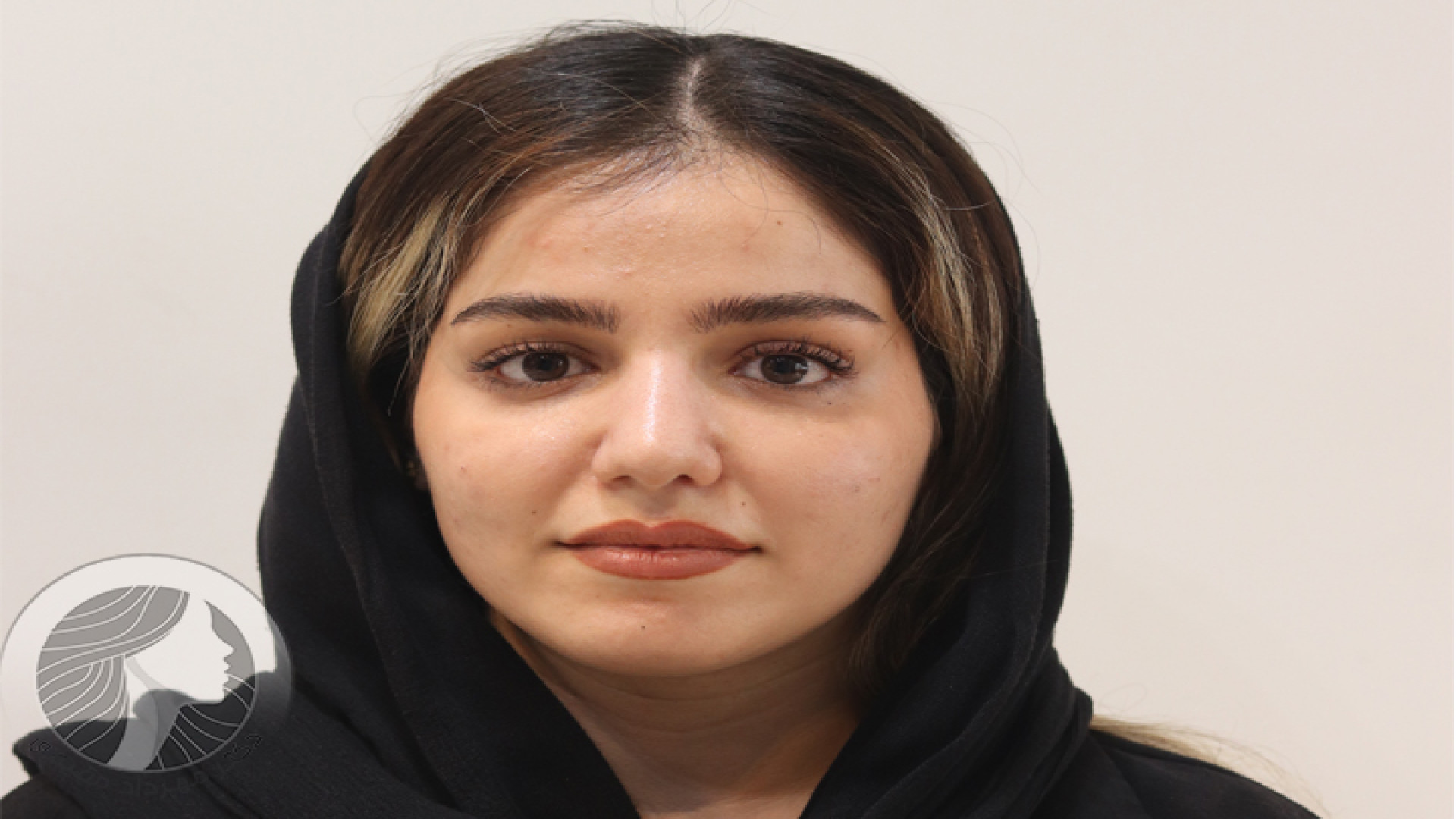 جراحی زیبایی بینی 2 ماه بعد از عمل - دکتر مهرداد مقیمی مهر 1402 دکتر مهرداد مقیمی