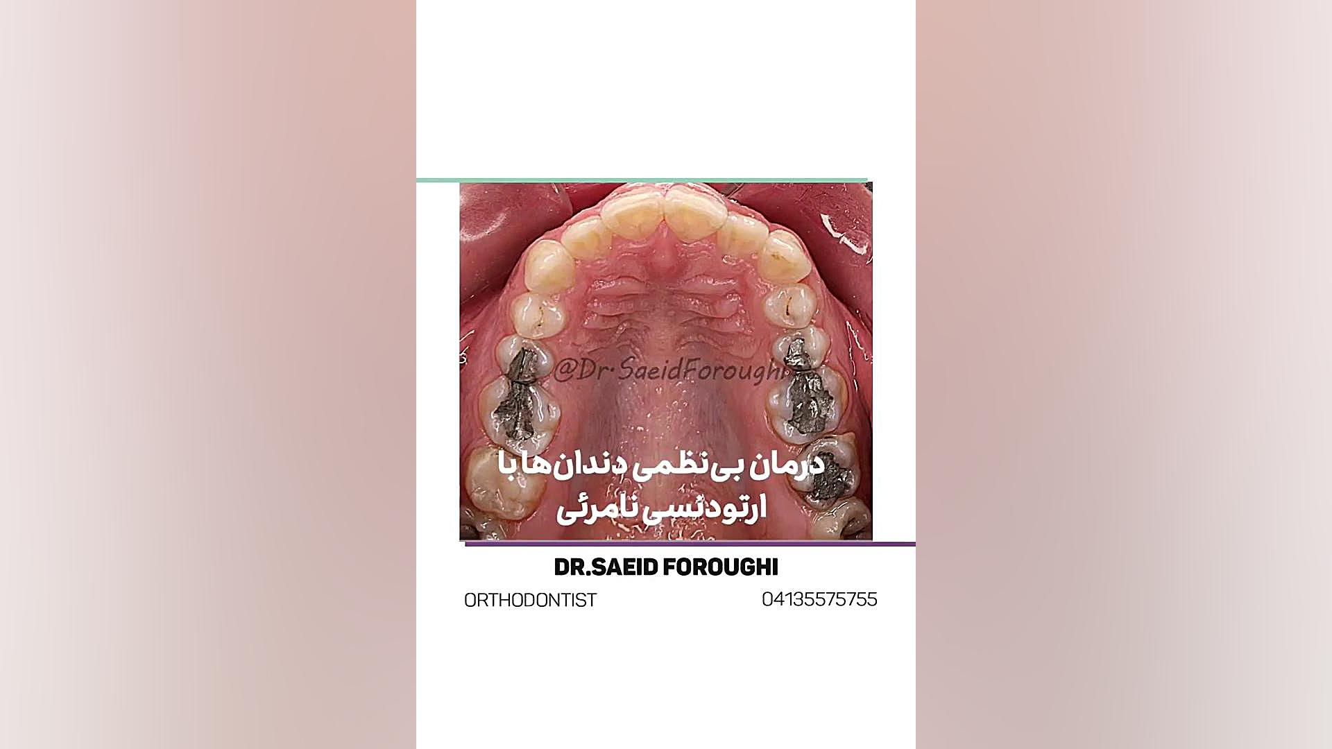 درمان بینظمی دندانهای دو فک توسط ارتودنسی نامرئی دکتر سعید فروغی متخصص ارتودنسی
