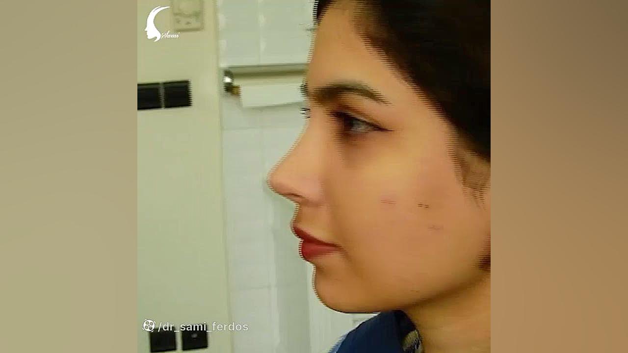 اصلاح بینی پروجکت و غیر قرینه با اصلاح نسبی نمای لثه ای در خنده لوسارتان
