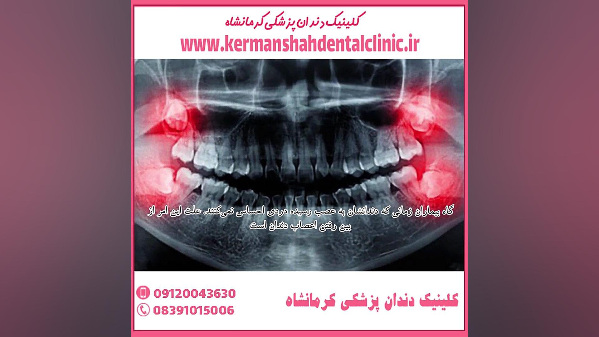 عصب کشی دندان ارنیزوماب