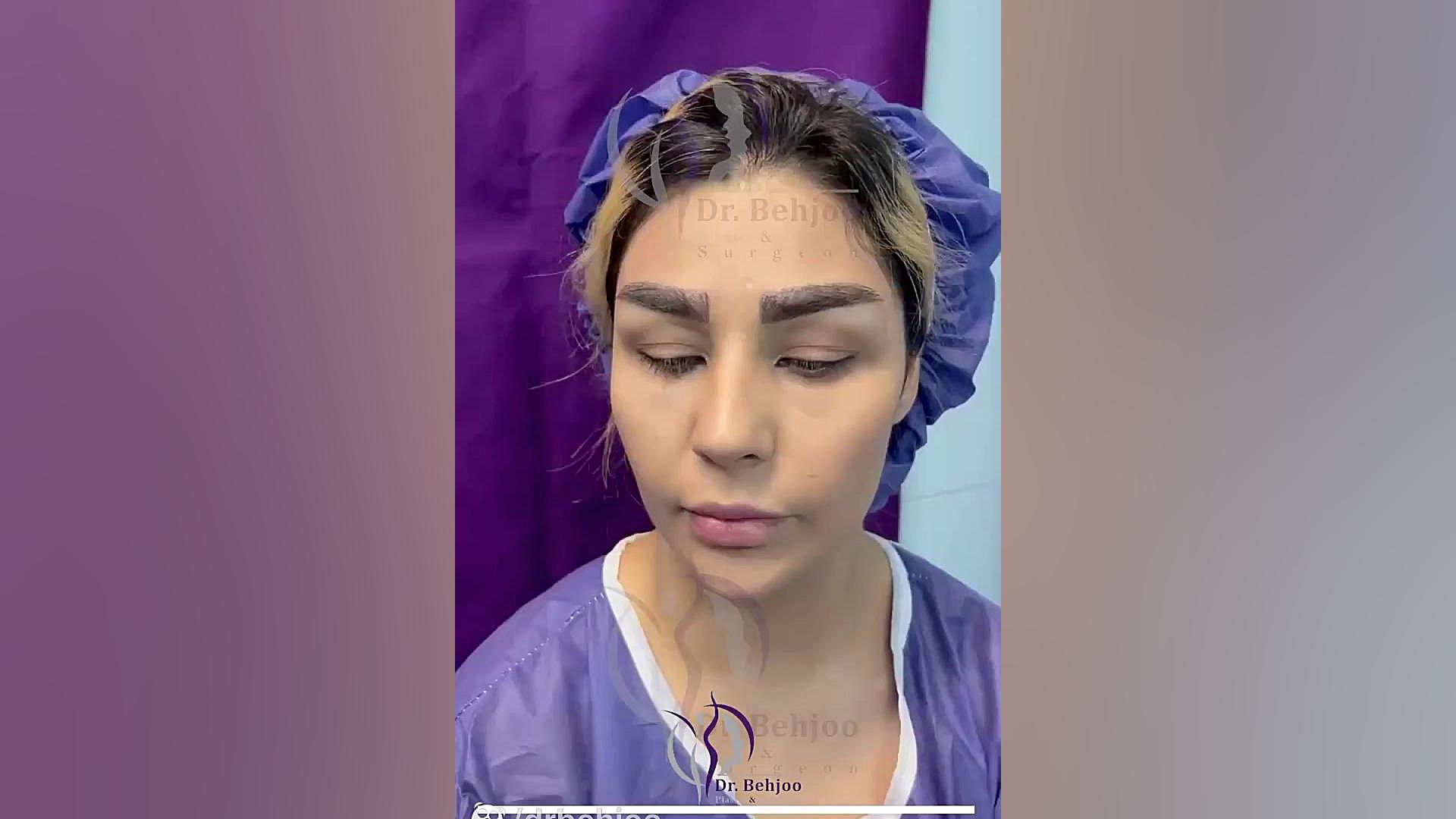 جراحی لیفت اندوسکوپی به همراه تراش استخوان دکتر شاهین بهجو - فوق تخصص جراحی پلاستیک