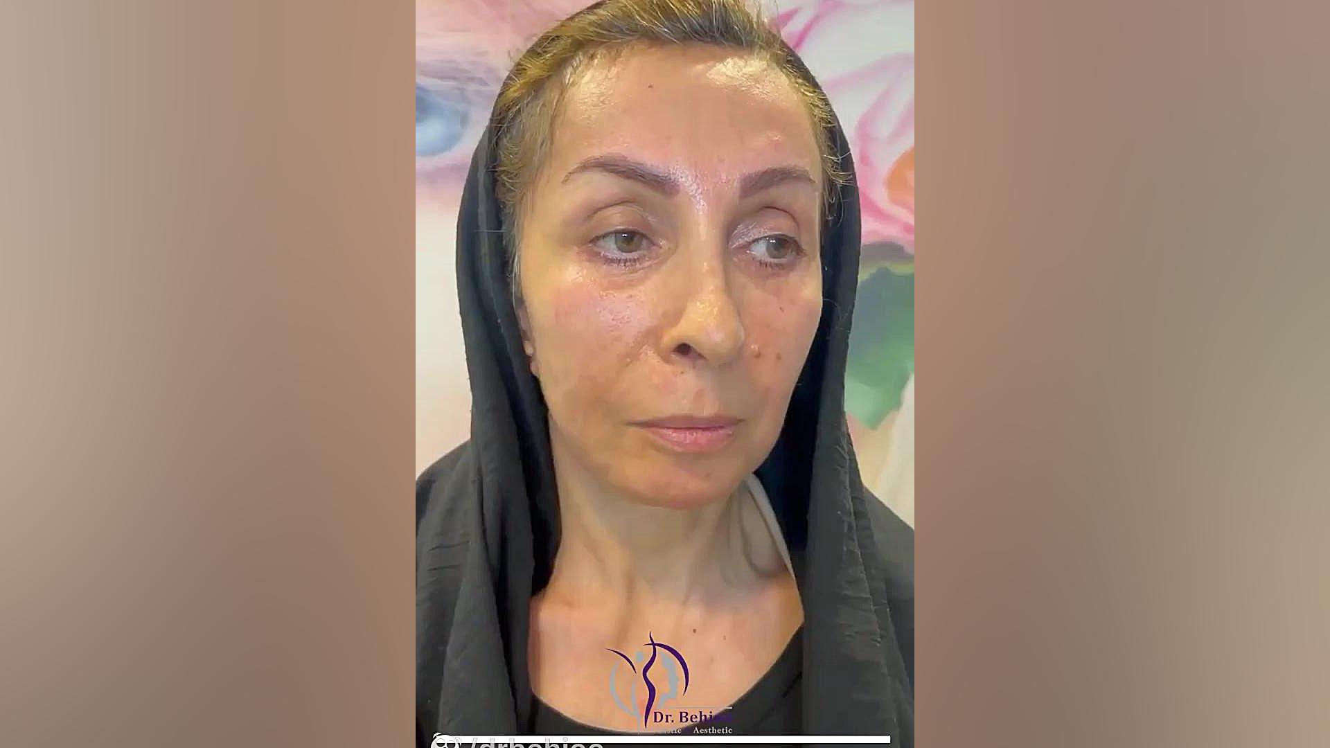 ۴۵ روز بعد از لیفت اندوسکوپی دکتر شاهین بهجو - فوق تخصص جراحی پلاستیک