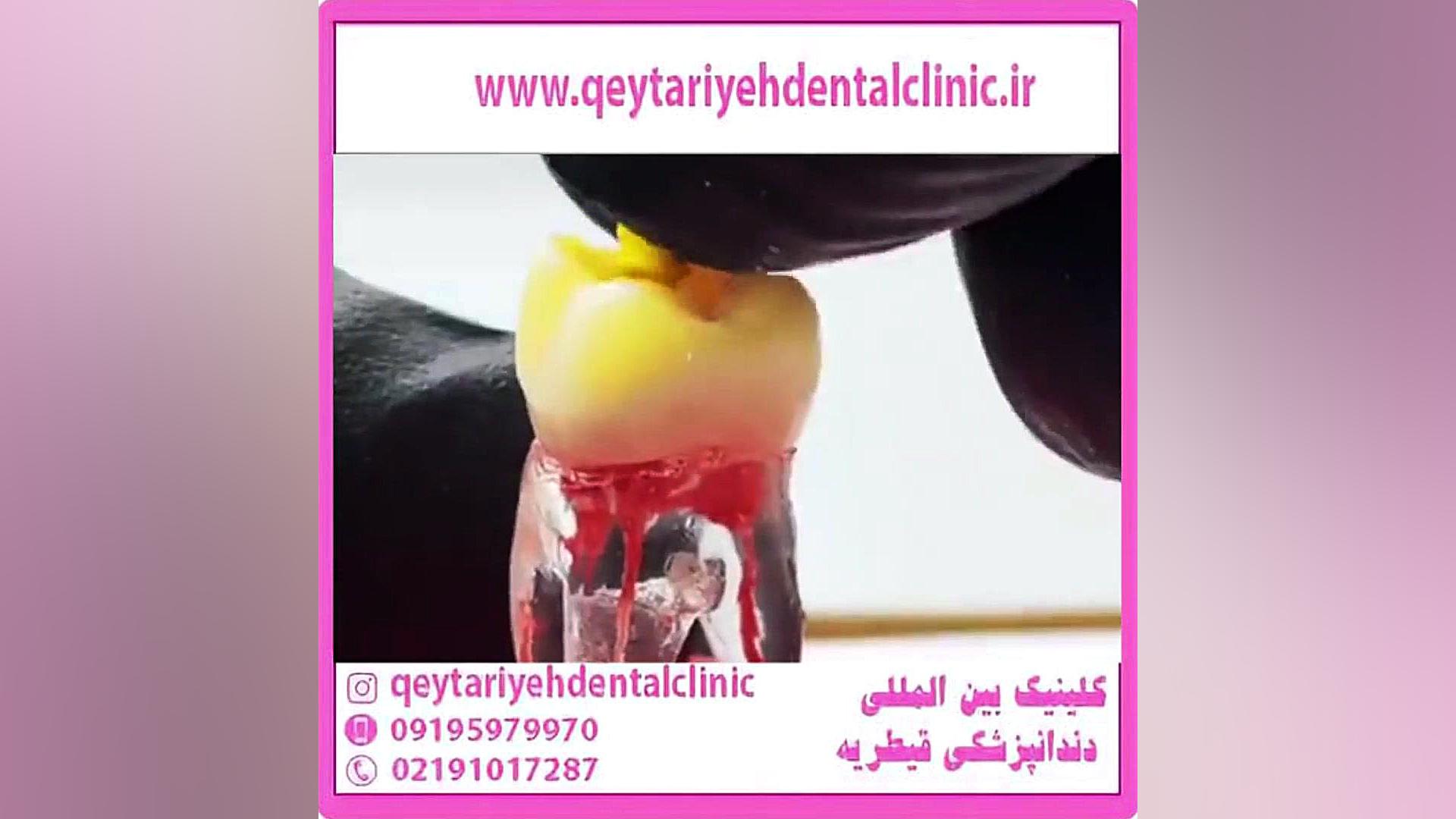 عصب کشی دندان ایریدوتيكان